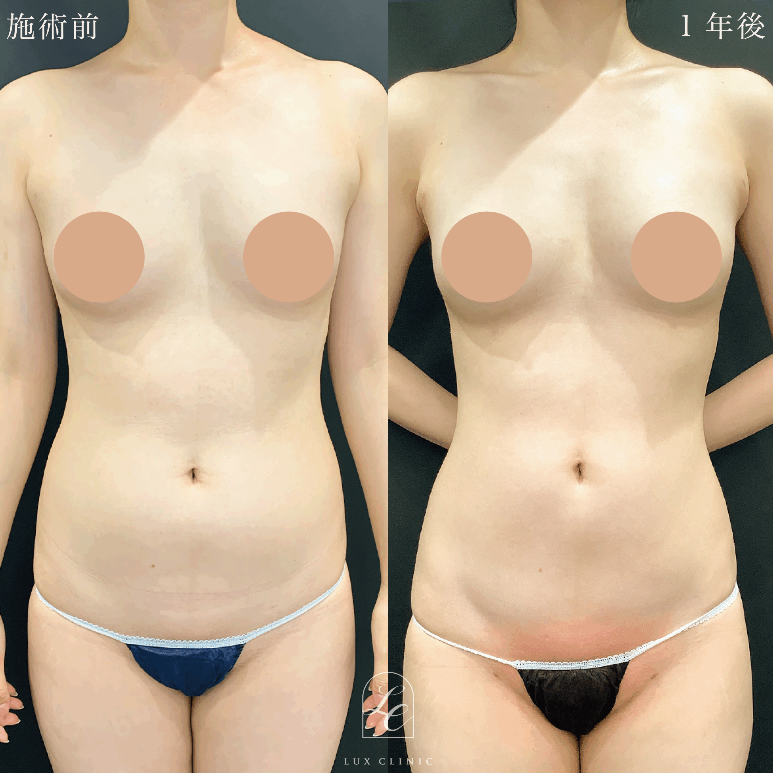 Ultra-Z 脂肪吸引 <腹部全面(上・下)・脇腹・腰>