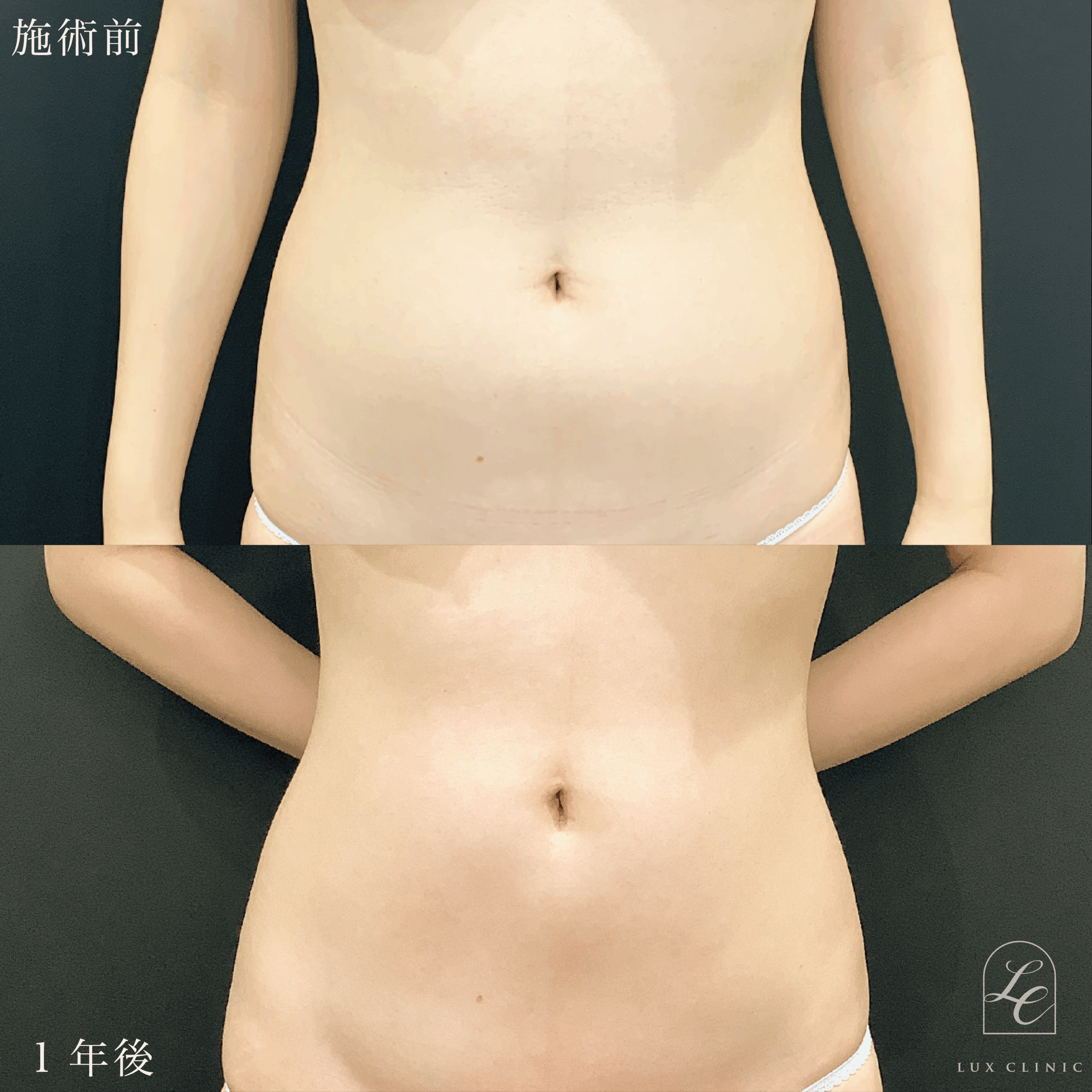 Ultra-Z 脂肪吸引 <腹部全面(上・下)・脇腹・腰>