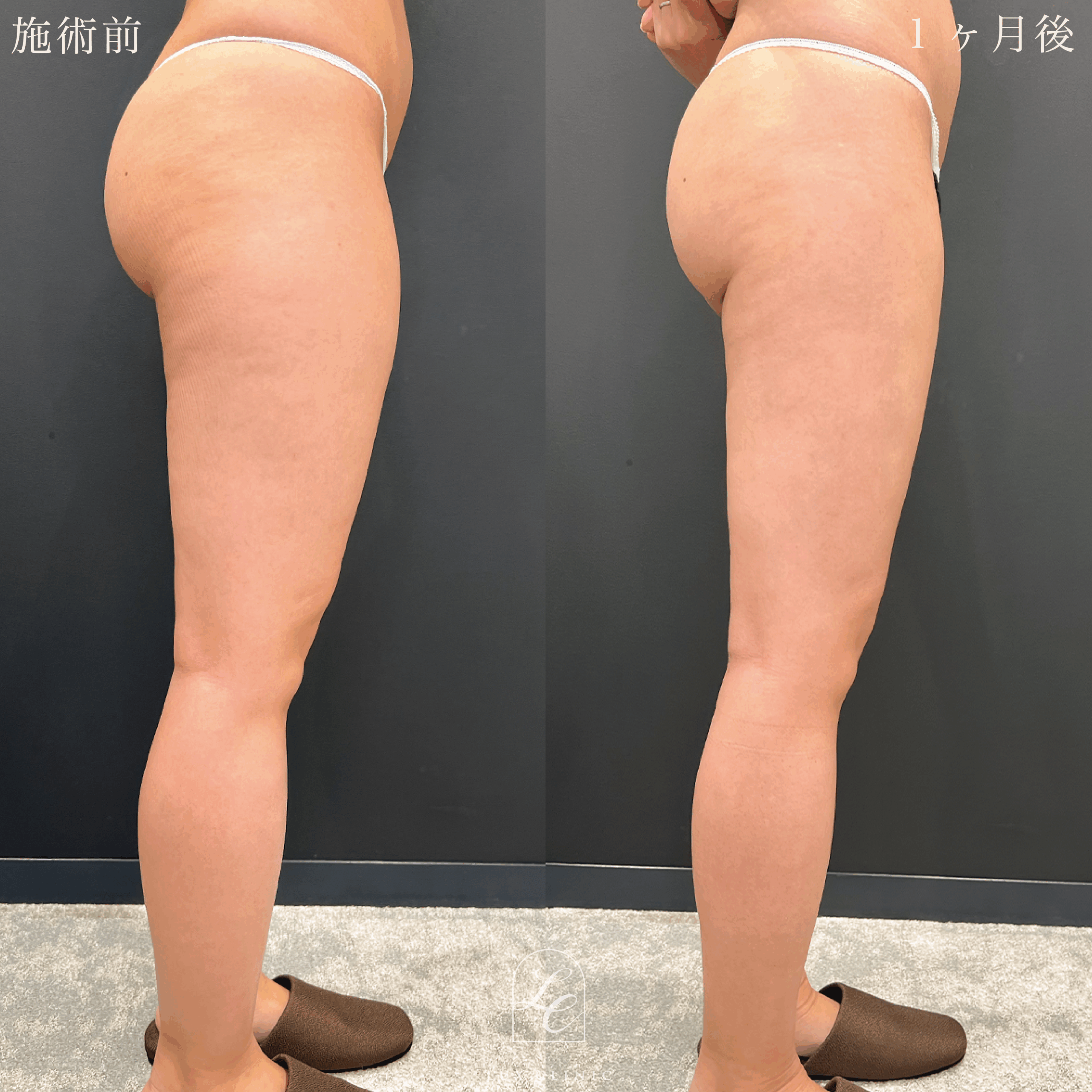 Ultra-Z 脂肪吸引 ＜大腿（全周）・臀部・膝・脹脛（全周）・足首＞