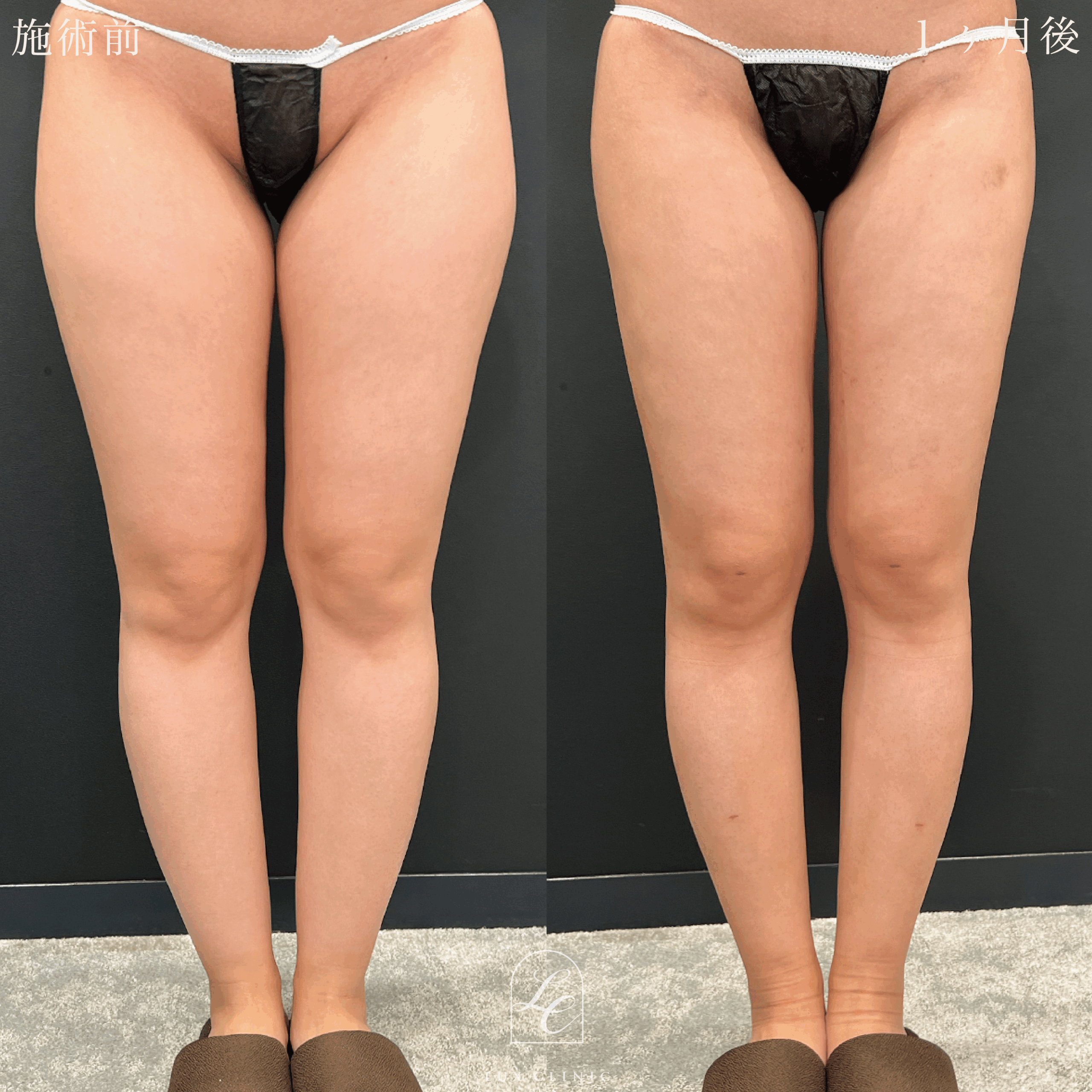 Ultra-Z 脂肪吸引 ＜大腿（全周）・臀部・膝・脹脛（全周）・足首＞