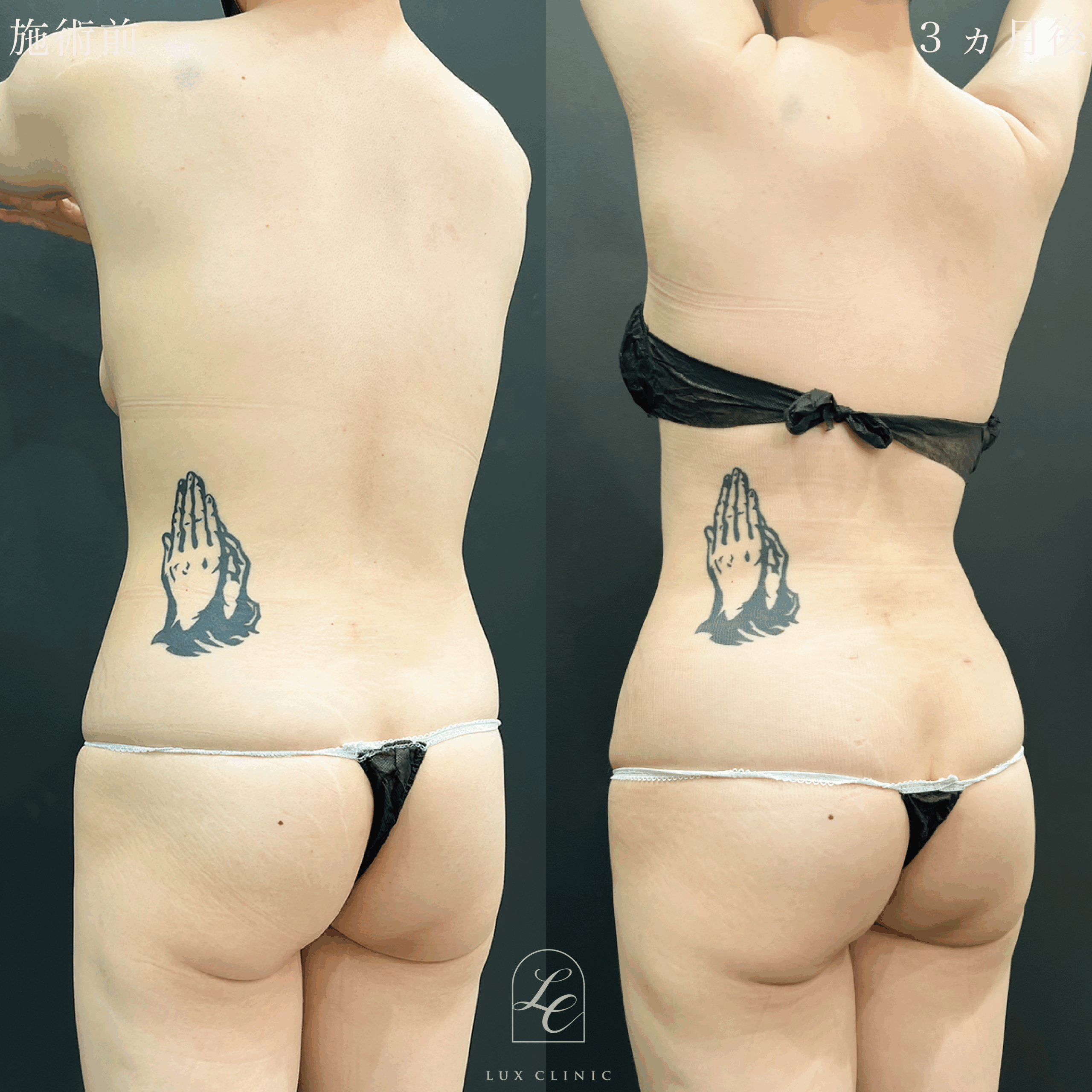 Ultra-Z 脂肪吸引 ＜腹部全面（上・下）・脇腹・腰＞