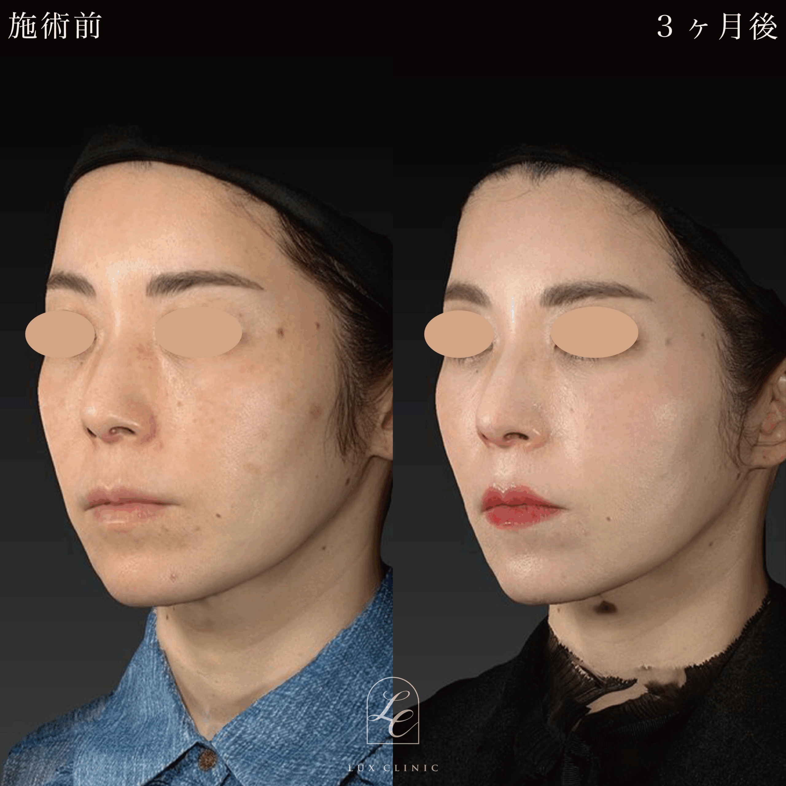 ミニフェイスリフト ＋ 糸リフト 10本