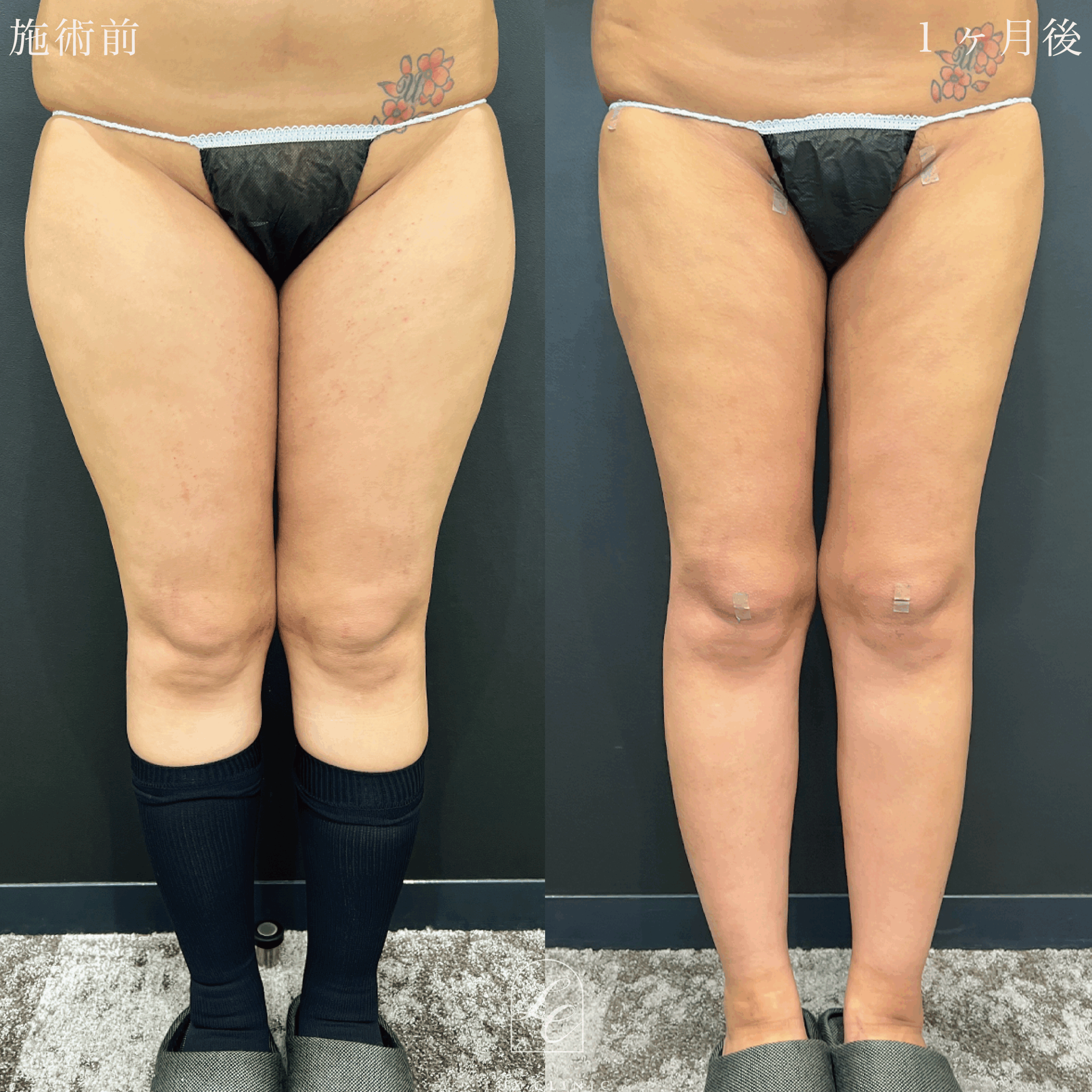 Ultra-Z 脂肪吸引 ＜大腿（全周）・臀部・膝＞