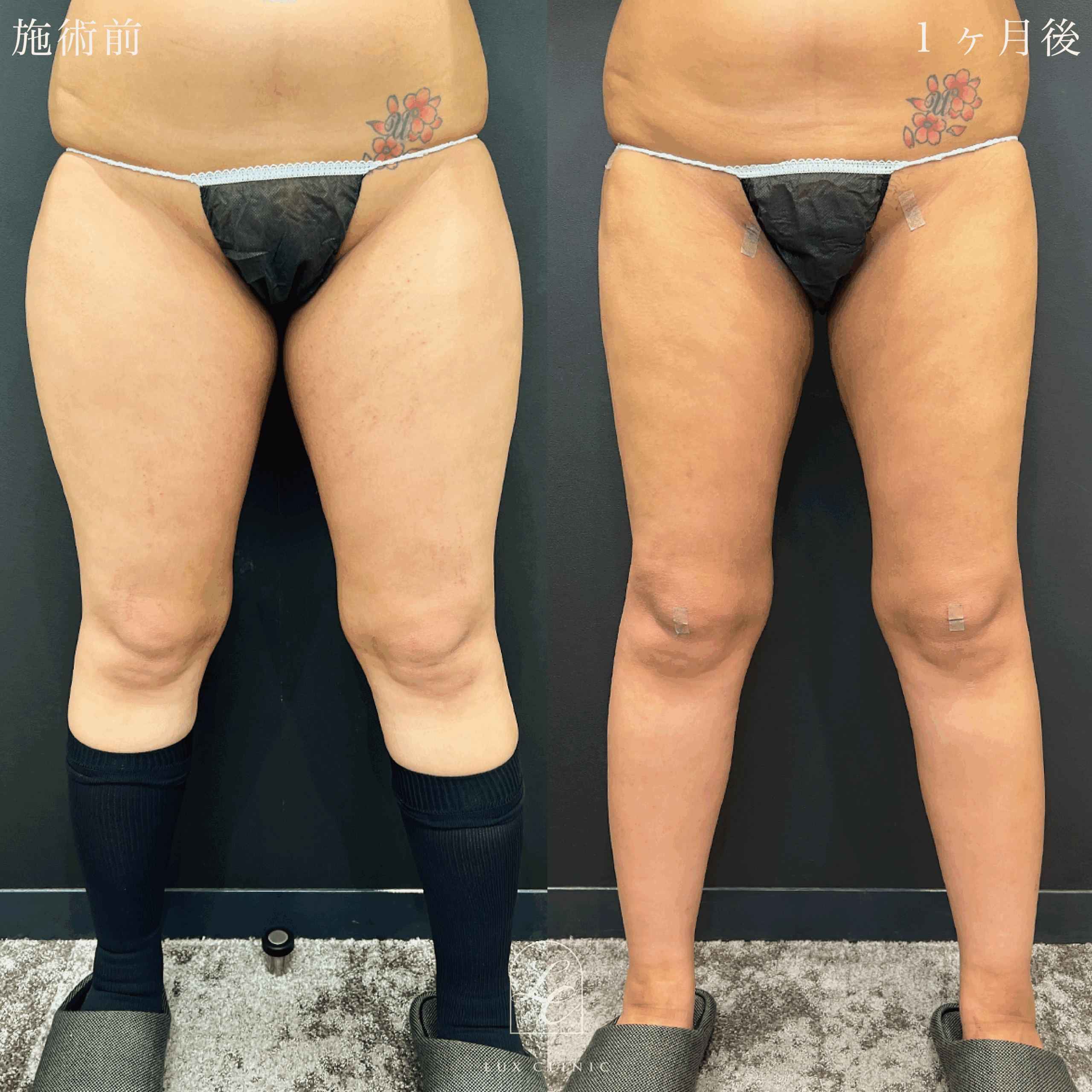 Ultra-Z 脂肪吸引 ＜大腿（全周）・臀部・膝＞