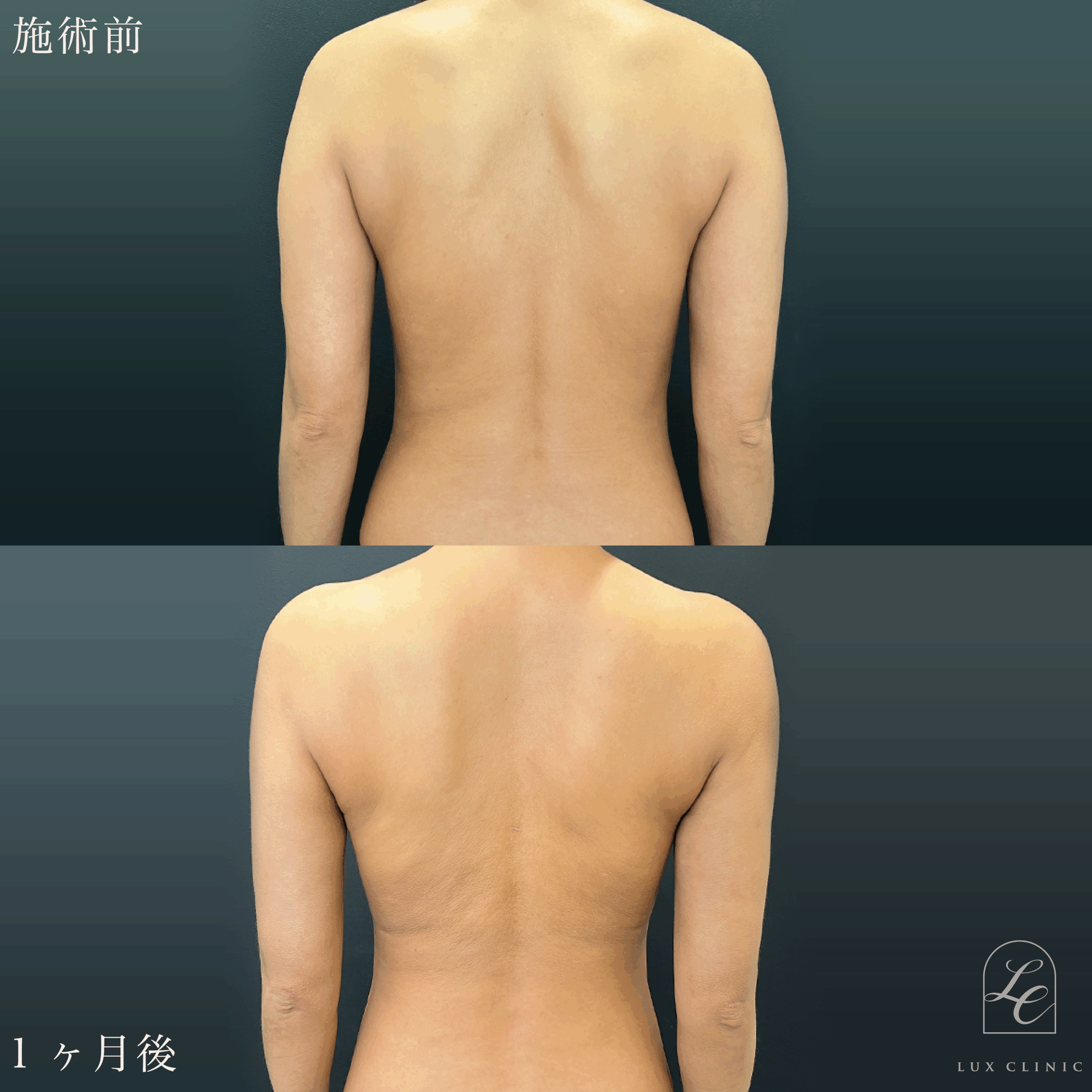 Ultra-Z 脂肪吸引 ＜二の腕後面・肩・肩甲骨横・ブラ（上・下）＞