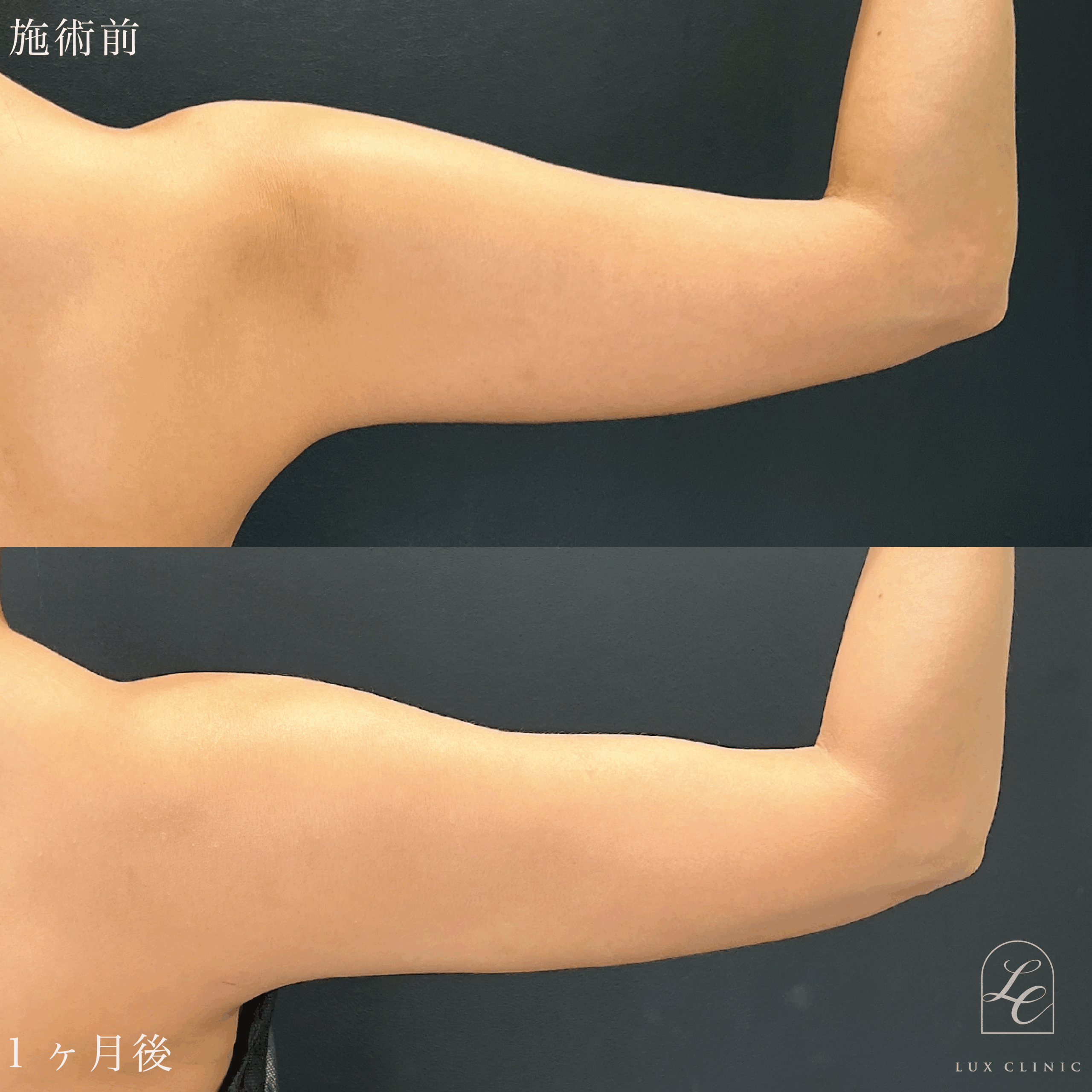 Ultra-Z 脂肪吸引 ＜二の腕後面・肩・肩甲骨横・ブラ（上・下）＞