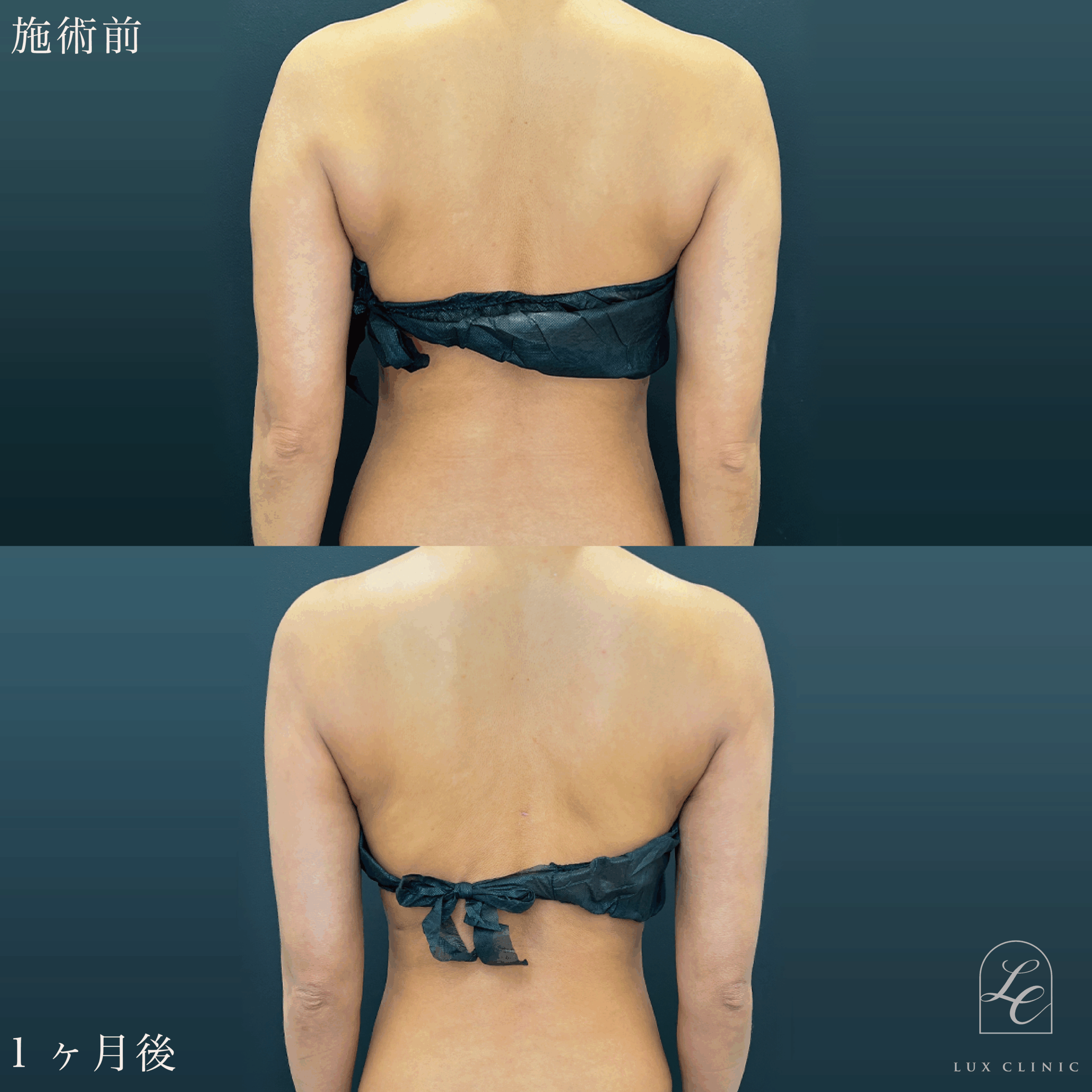 Ultra-Z 脂肪吸引 ＜二の腕後面・肩・肩甲骨横・ブラ（上・下）＞