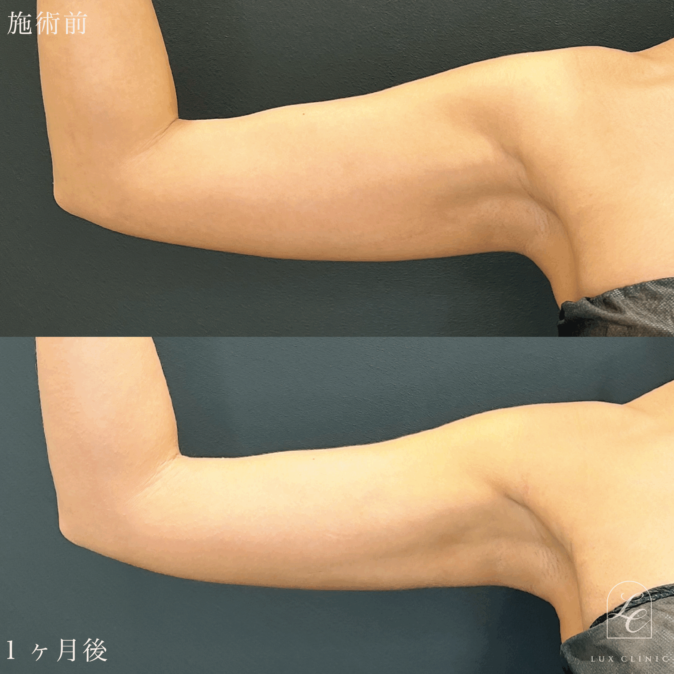 Ultra-Z 脂肪吸引 ＜二の腕後面・肩・肩甲骨横・ブラ（上・下）＞