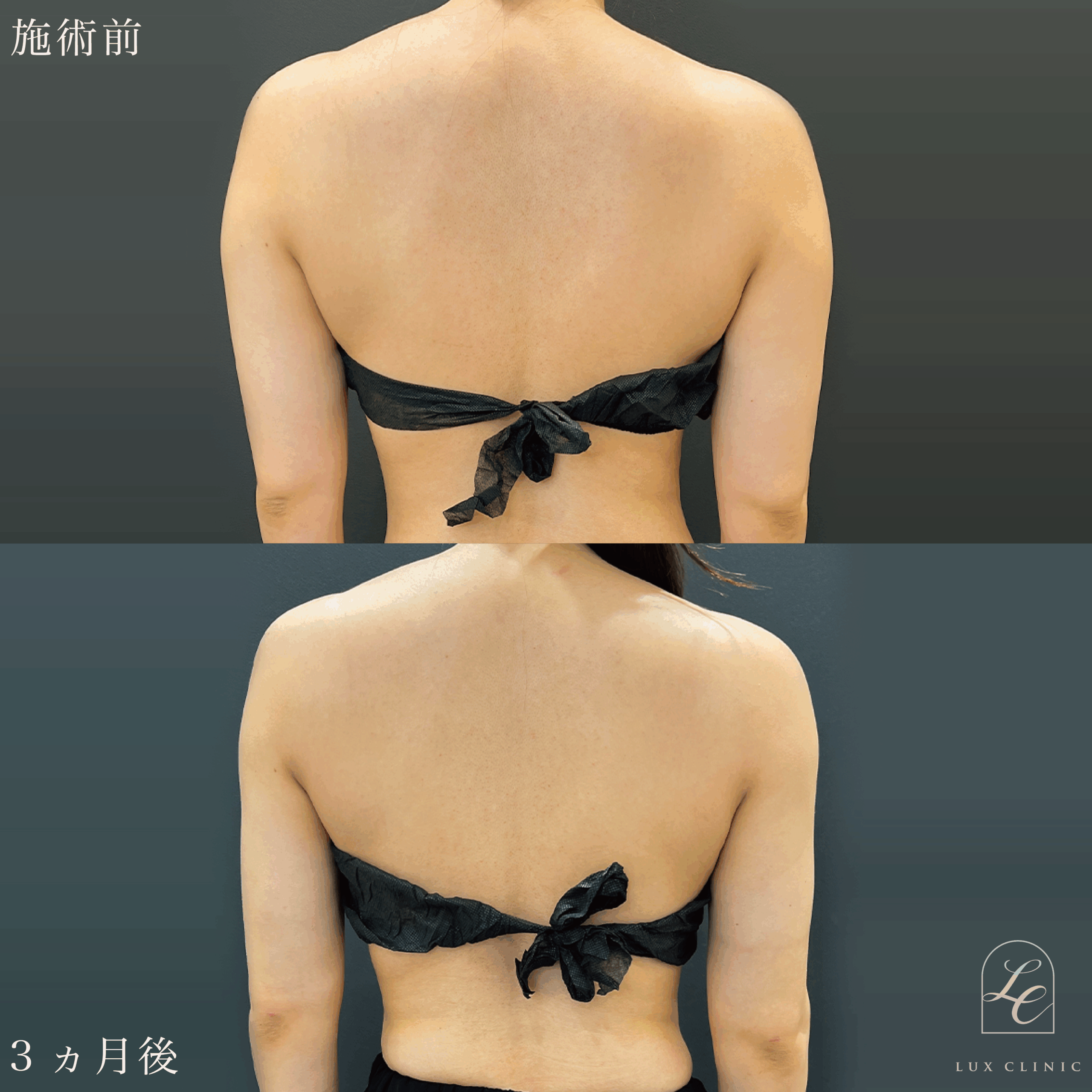 Ultra-Z 脂肪吸引 ＜二の腕（後面）・肩・肩甲骨横＞