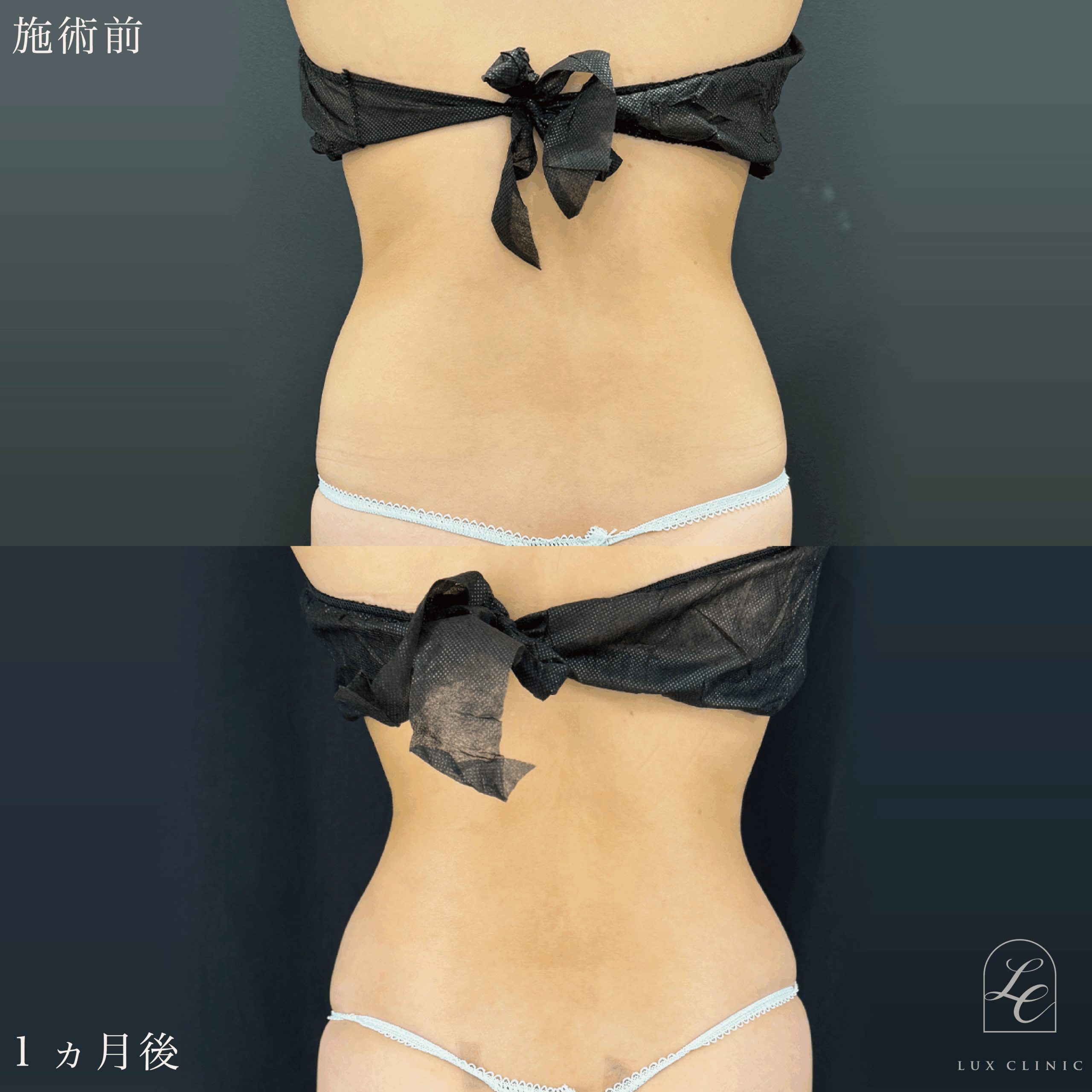 Ultra-Z 脂肪吸引 <腹部全面(上・下)・脇腹(前・後)・腰>