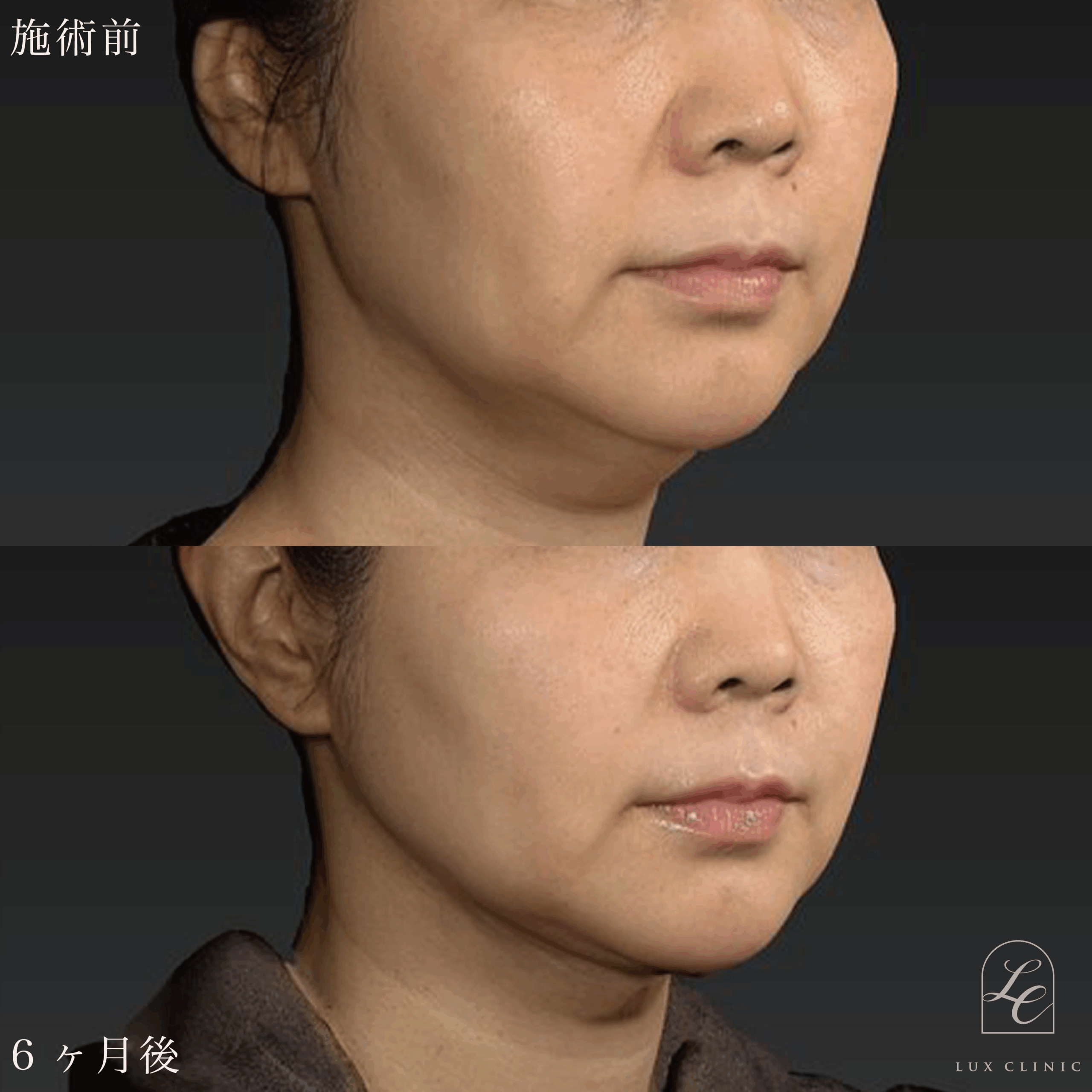 Ultra-Z 脂肪吸引＜あご下＞＋ 糸リフト（テスリフト 10本・BNLS Ultimate Lifting 4本）＋ヒアルロン酸（レスチレン 3本）＜頬、口角、こめかみ＞