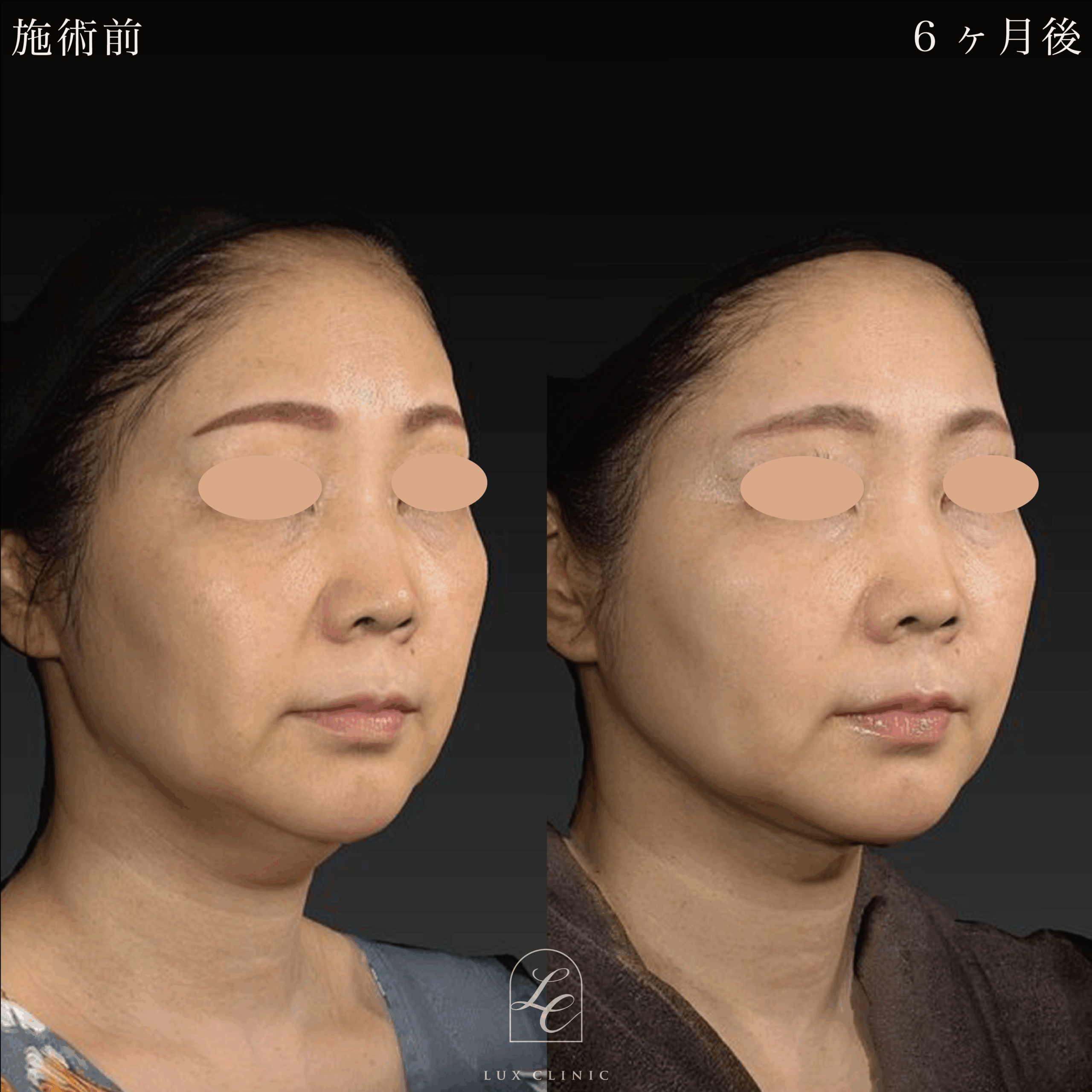 Ultra-Z 脂肪吸引＜あご下＞＋ 糸リフト（テスリフト 10本・BNLS Ultimate Lifting 4本）＋ヒアルロン酸（レスチレン 3本）＜頬、口角、こめかみ＞