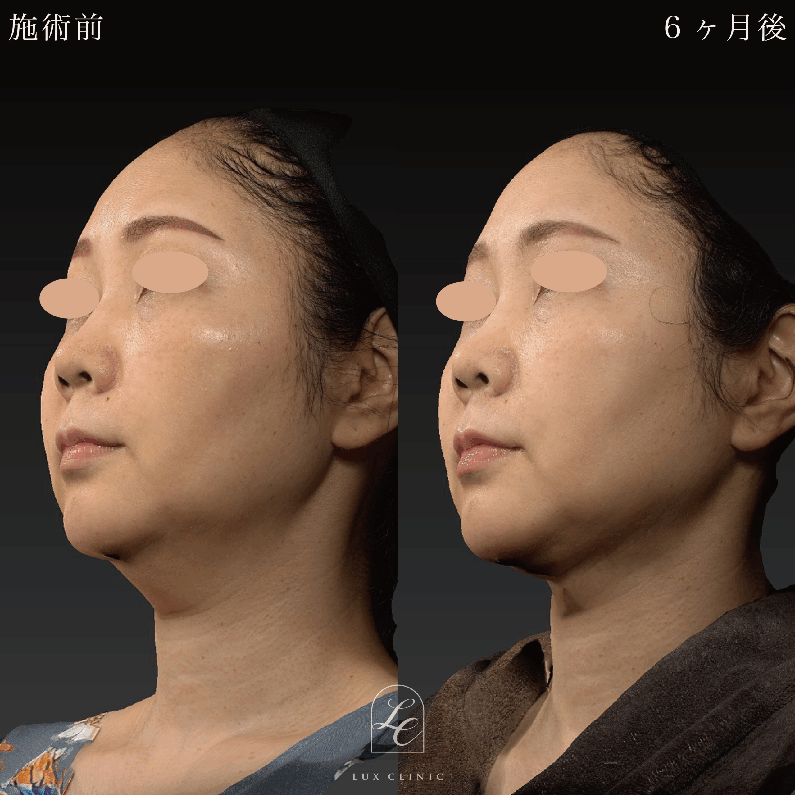 Ultra-Z 脂肪吸引<あご下>+ 糸リフト(テスリフト 10本・BNLS Ultimate Lifting 4本)+ヒアルロン酸(レスチレン 3本)<頬、口角、こめかみ>