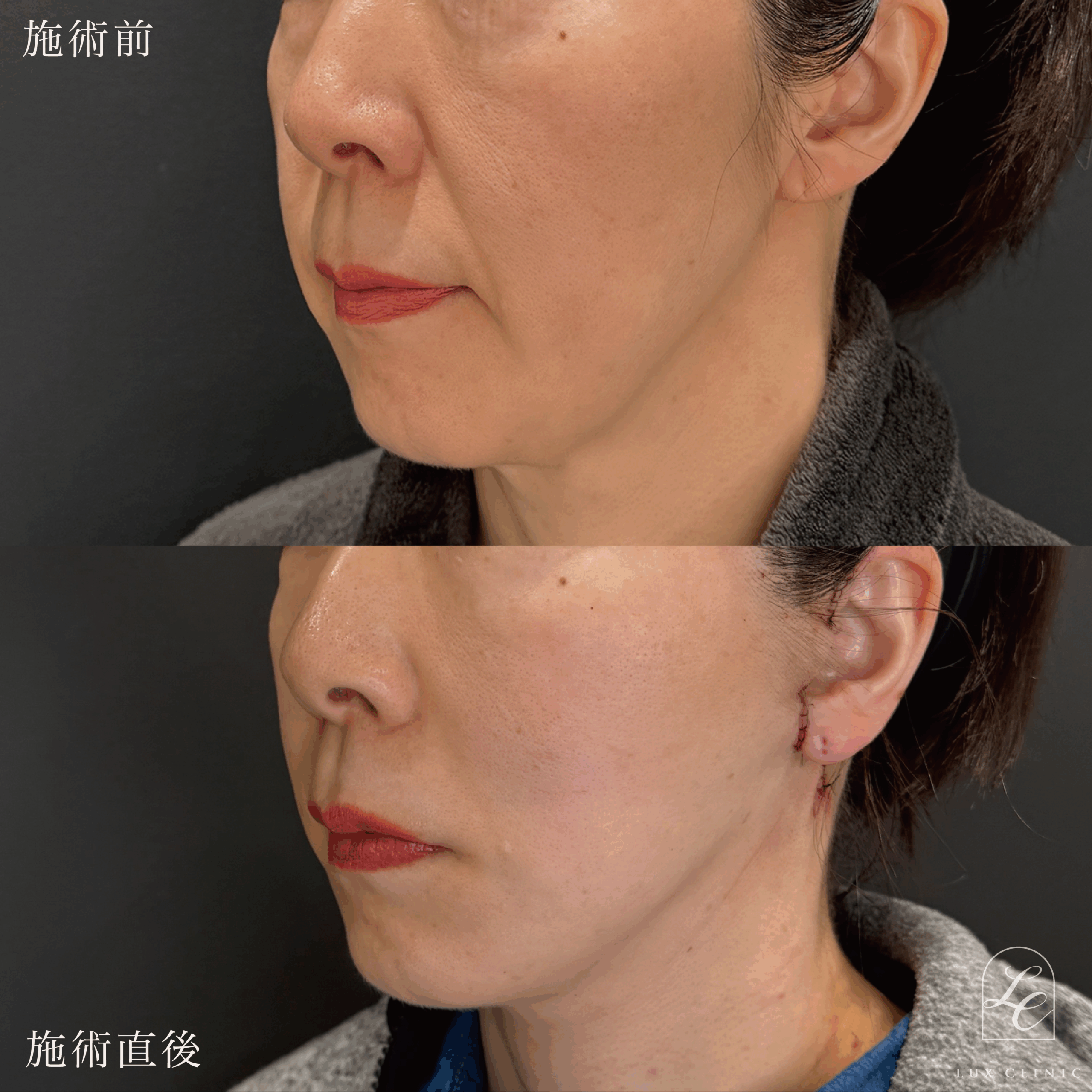 ミニフェイスリフト ＋ ヒアルロン酸（ジュビダームビスタ®シリーズ ボライト2本）＜首＞