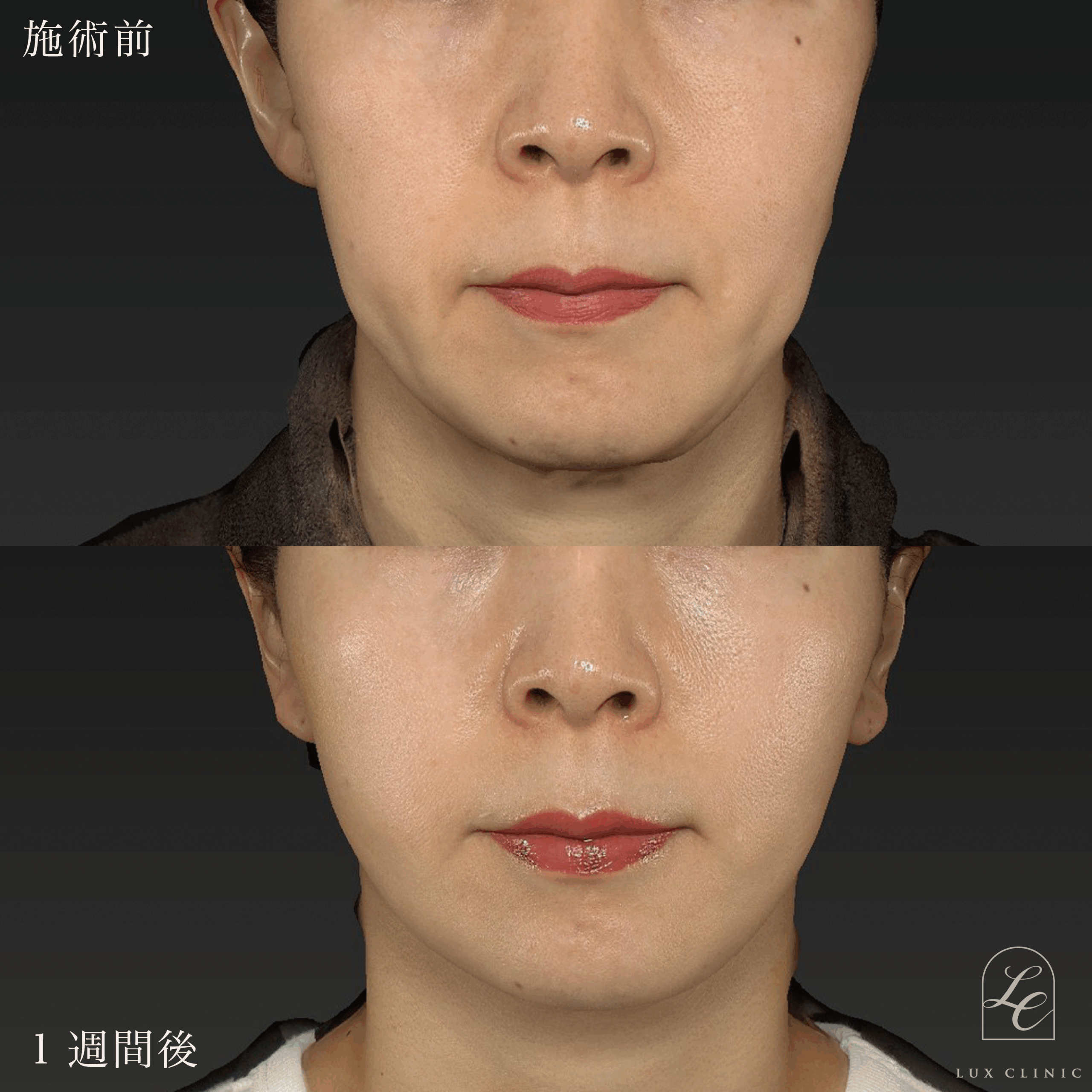 ミニフェイスリフト ＋ ヒアルロン酸（ジュビダームビスタシリーズ ボライト2本）＜首＞