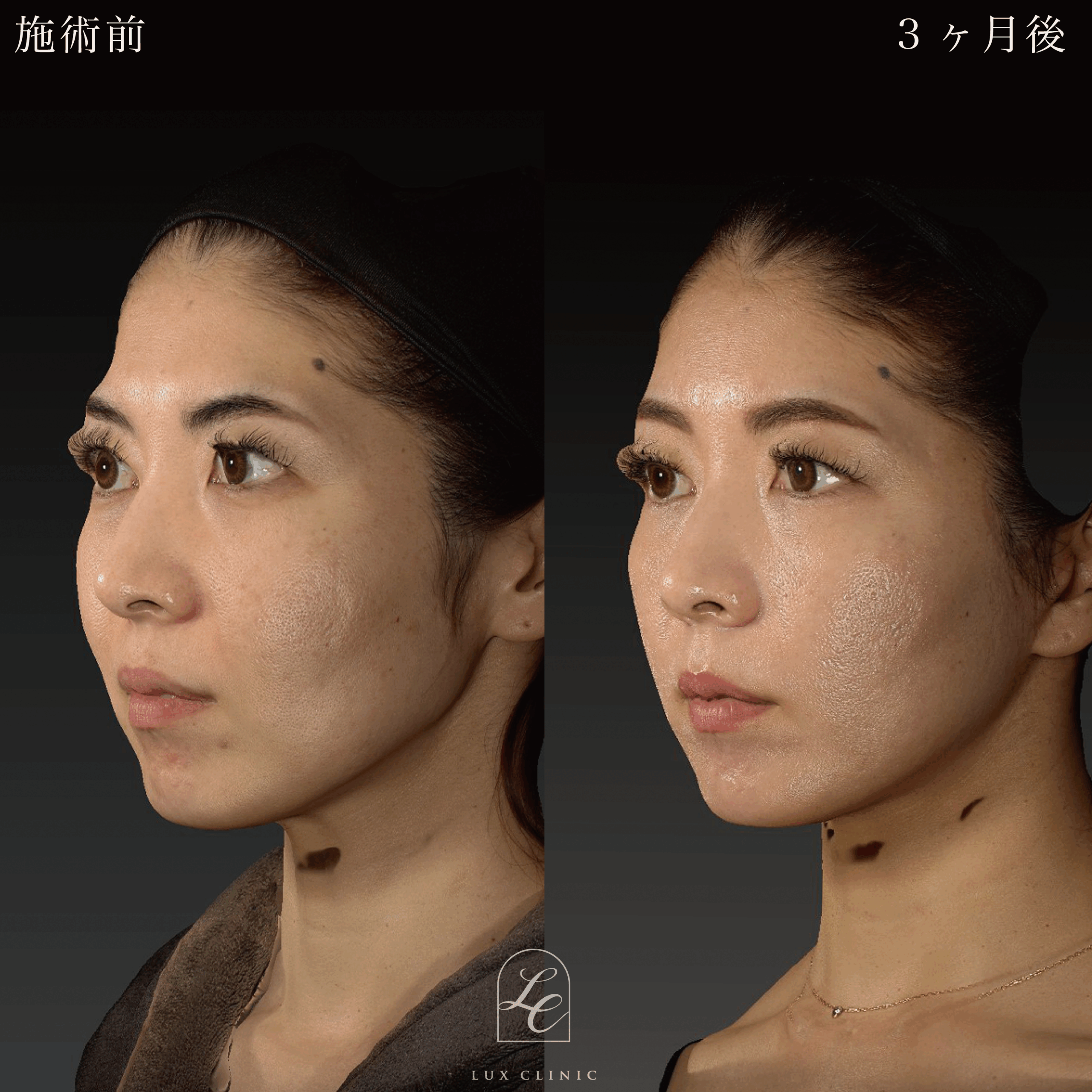 ミニフェイスリフト ＋ もみあげリフト ＋コンデンスリッチ脂肪注入 ＜顔全体・首＞ ※顔出しモニター