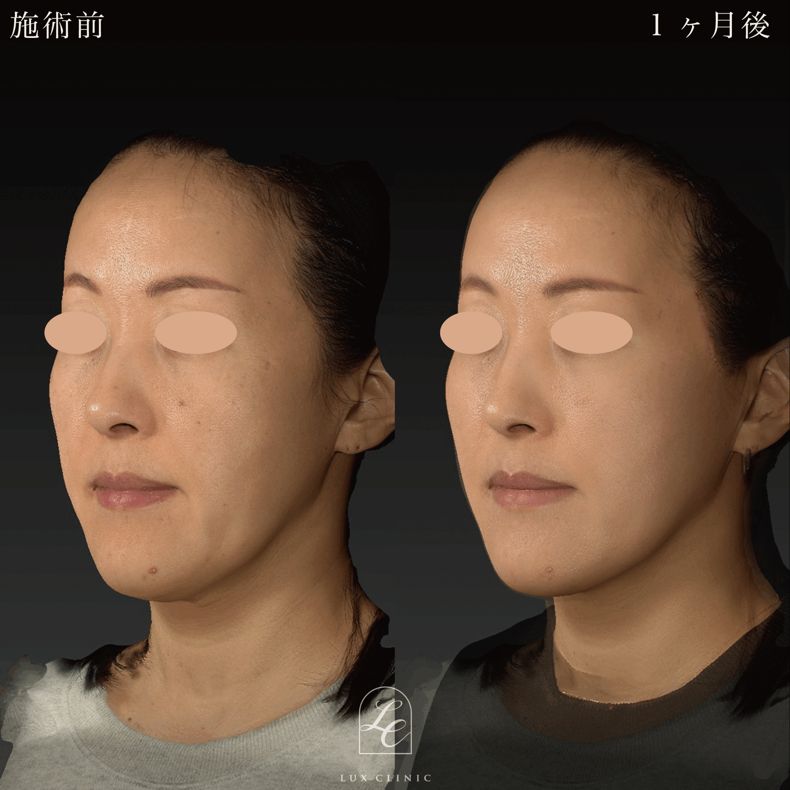 もみあげリフト