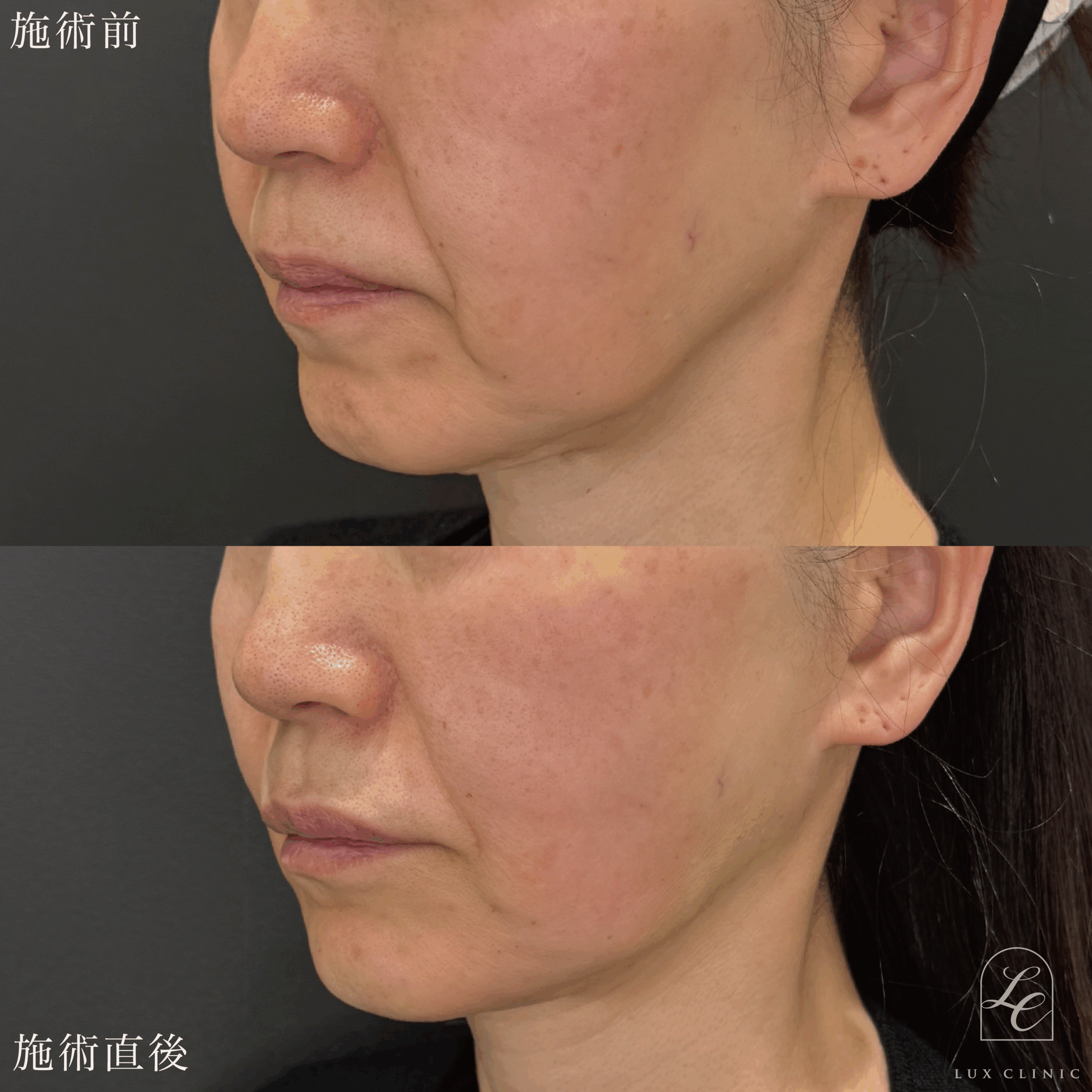 糸リフト（フィオラスレッドFL 4本）＋ヒアルロン酸（レスチレン 4本）＜口角、あご、頬＞