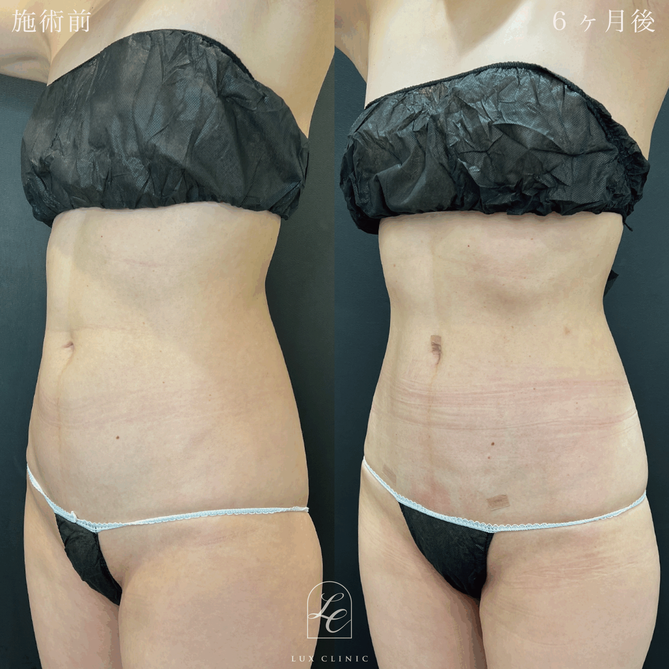 Ultra-Z 脂肪吸引 ＜腹部前面（上・下）・脇腹（前）＞