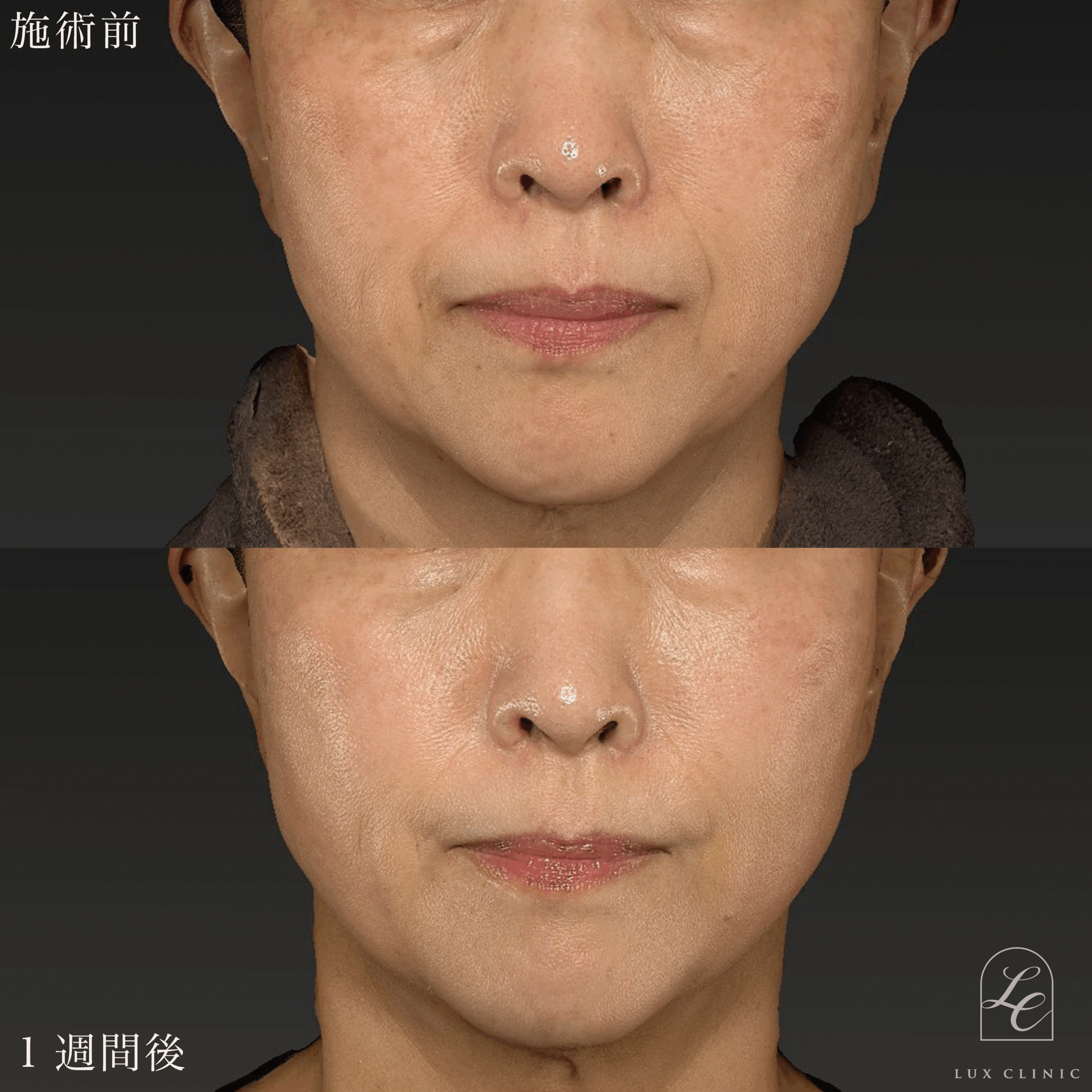 糸リフト（テスリフト 6本）＋ ヒアルロン酸（ニューラミス2本）＜ほうれい線・口角＞