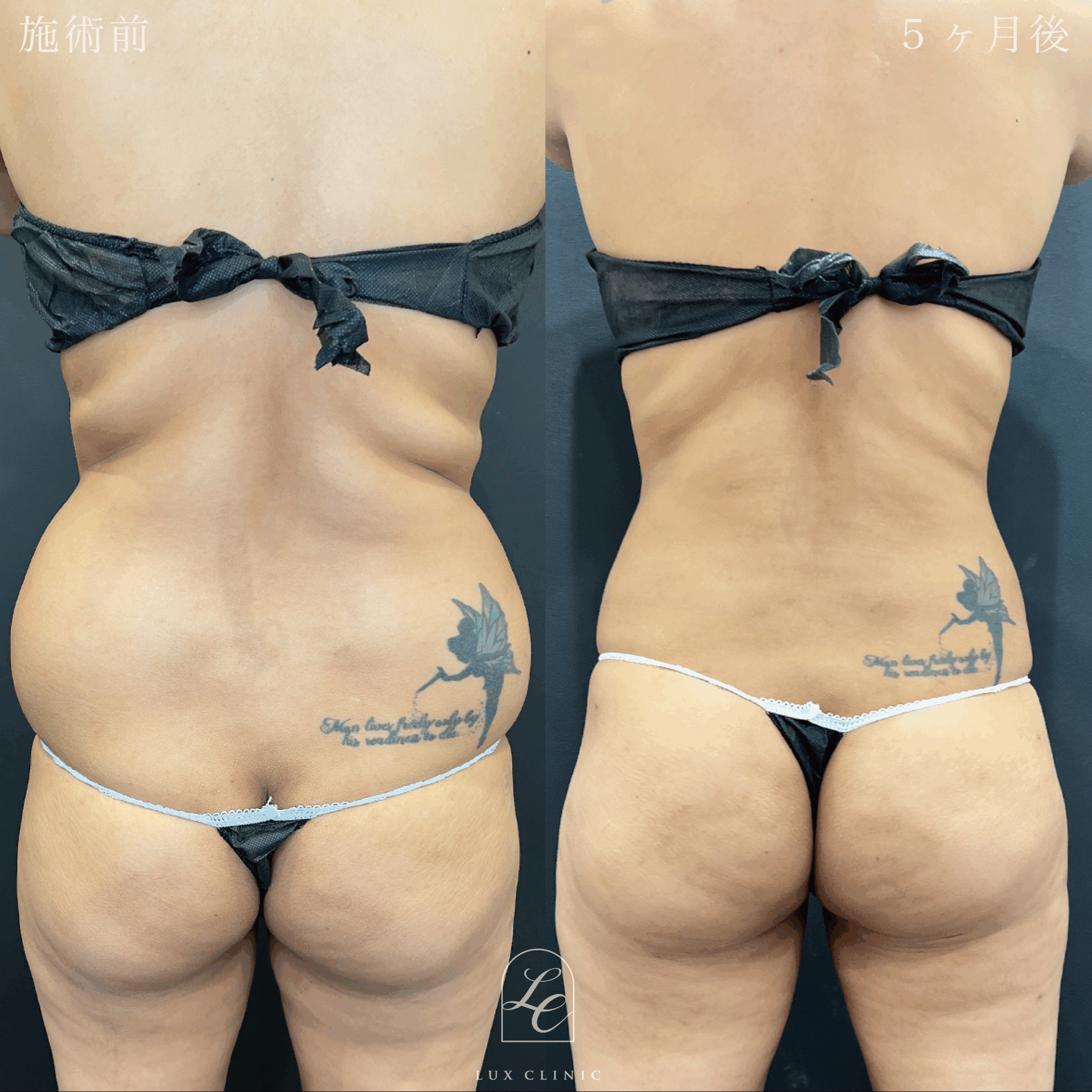 Ultra-Z 脂肪吸引 ＜腹部前面（上・下）・脇腹（前・後）・腰・ブラ下＞