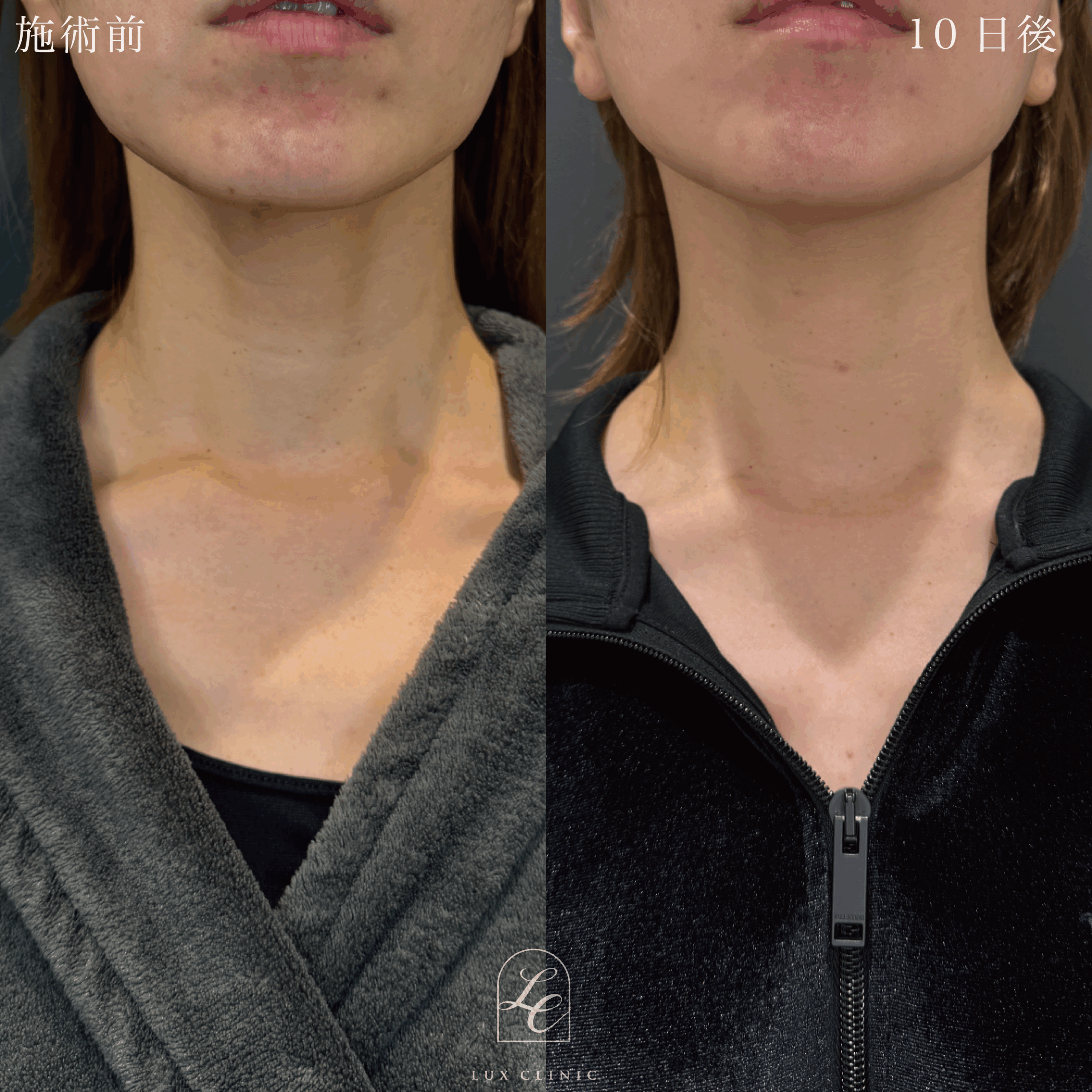 ミニフェイスリフト ＋ もみあげリフト ＋コンデンスリッチ脂肪注入 ＜顔全体・首＞ ※顔出しモニター