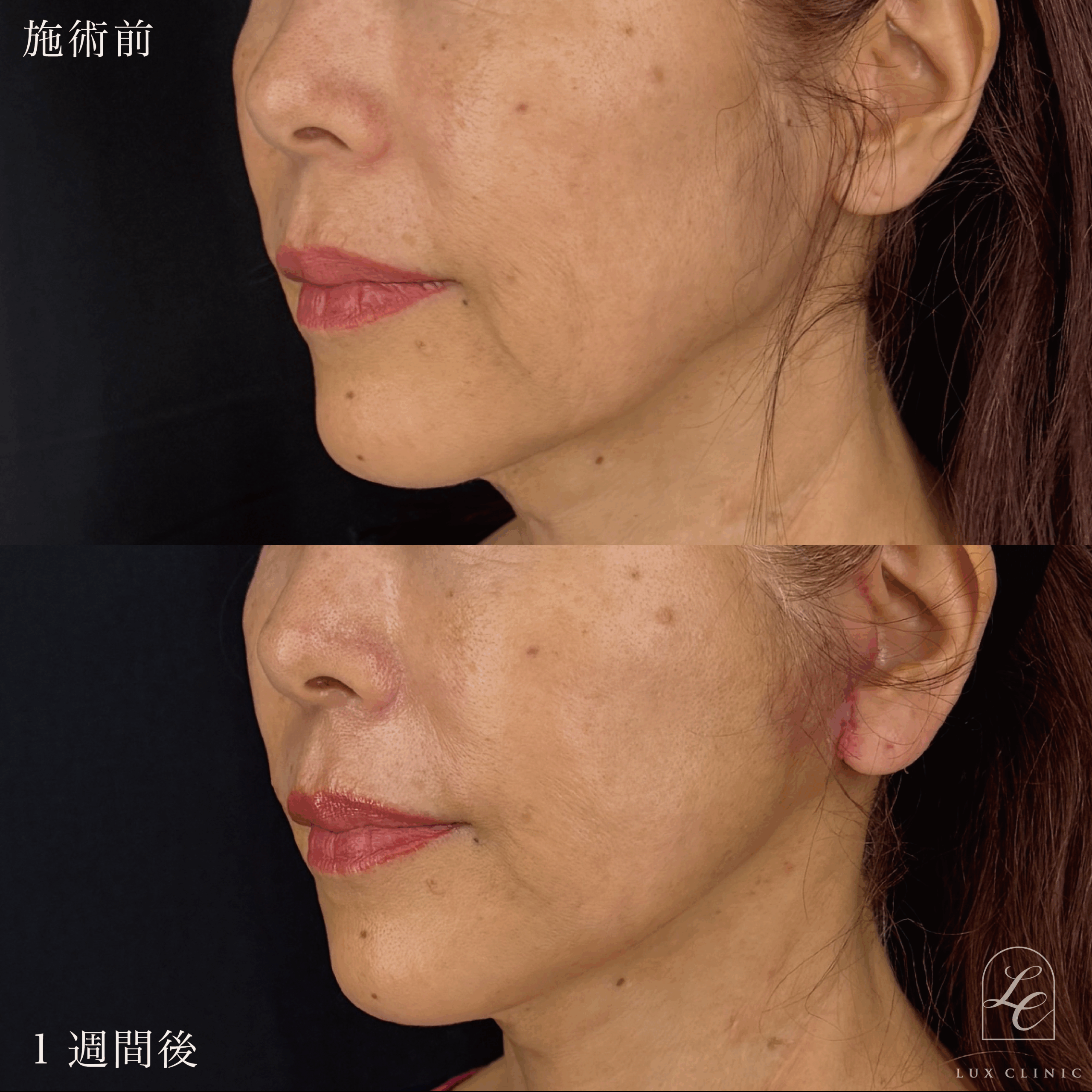 ミニフェイスリフト ＋ ヒアルロン酸（レスチレン4本）＜口横＞