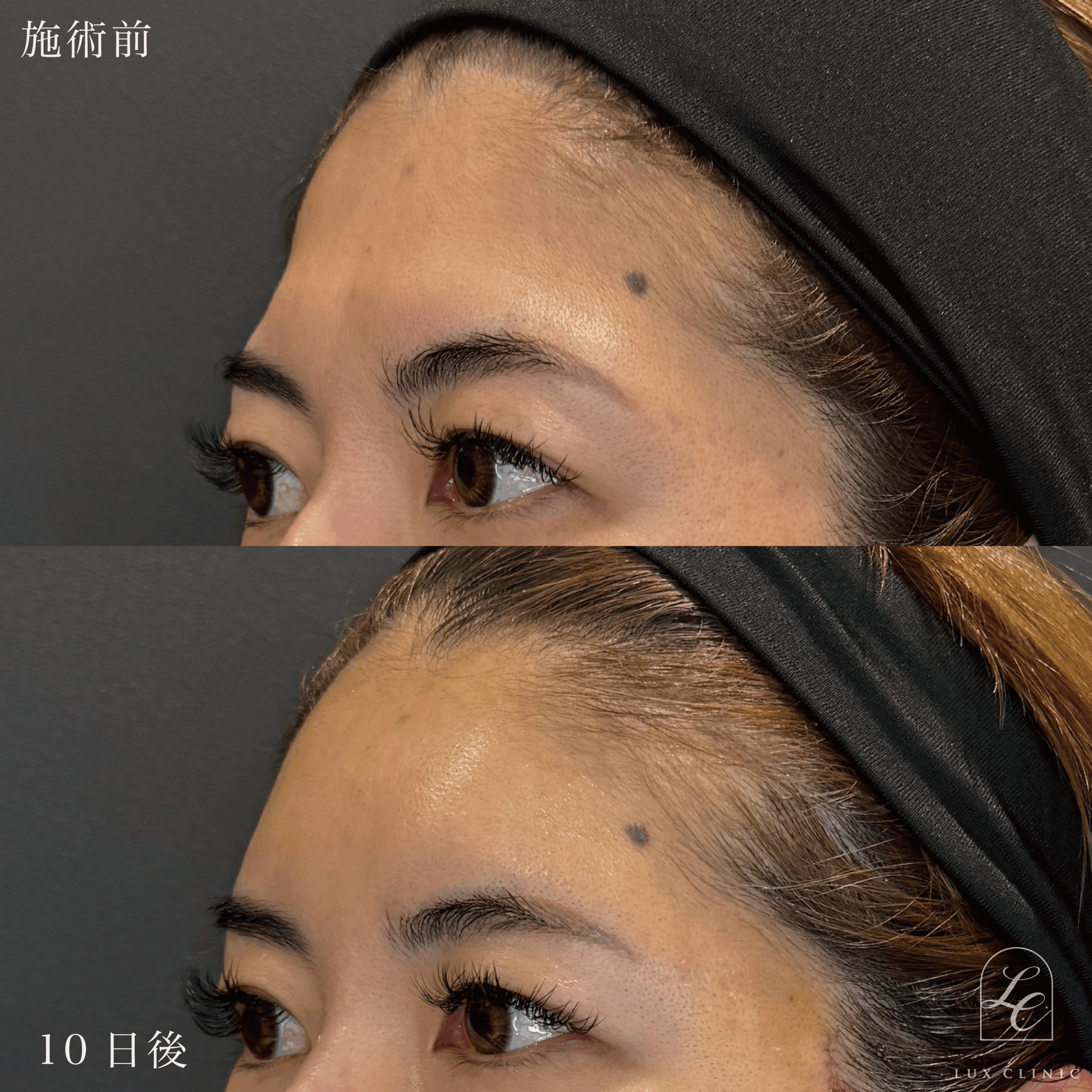 ミニフェイスリフト ＋ もみあげリフト ＋コンデンスリッチ脂肪注入 ＜顔全体・首＞ ※顔出しモニター