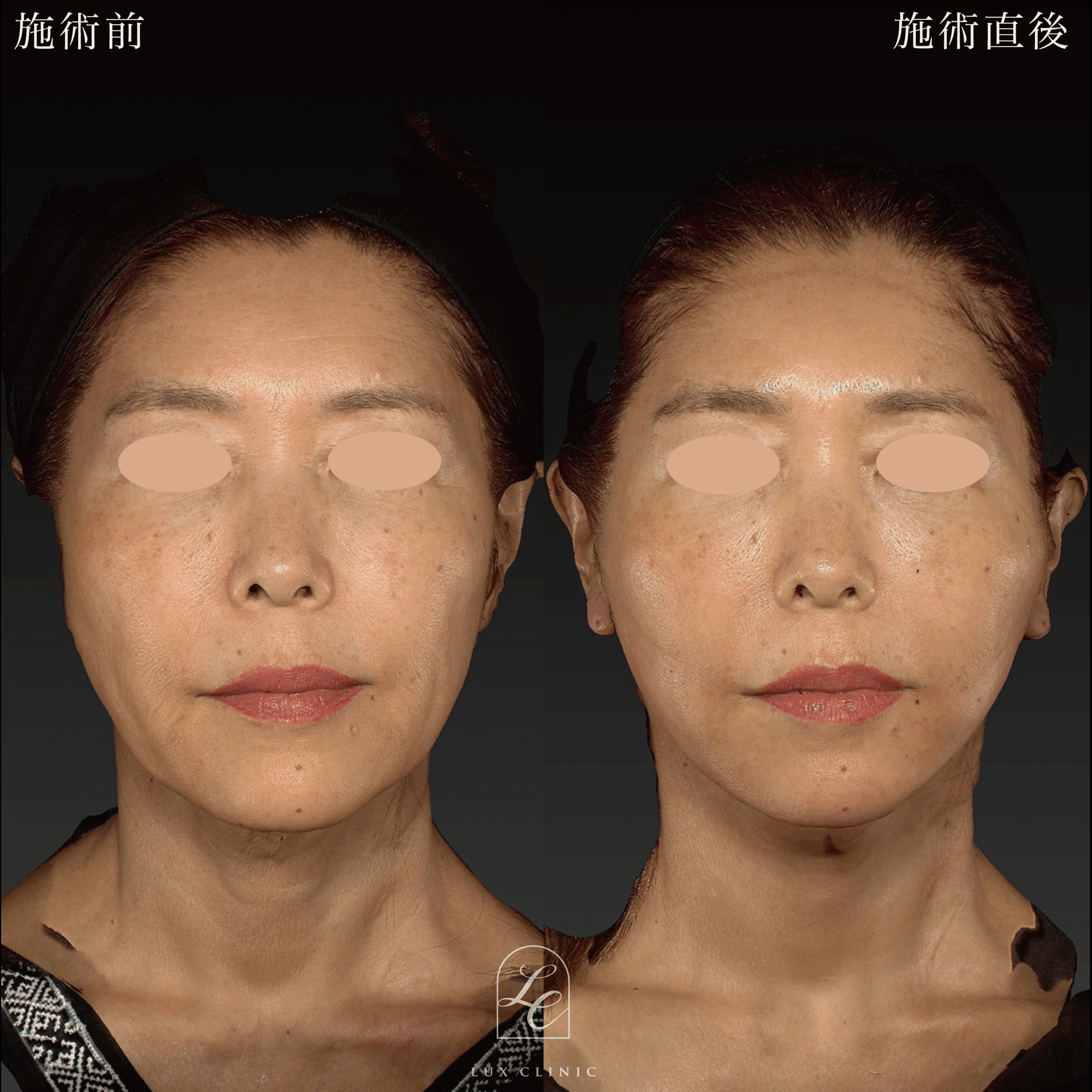 ミニフェイスリフト ＋ ヒアルロン酸（レスチレン2本）＜口横＞