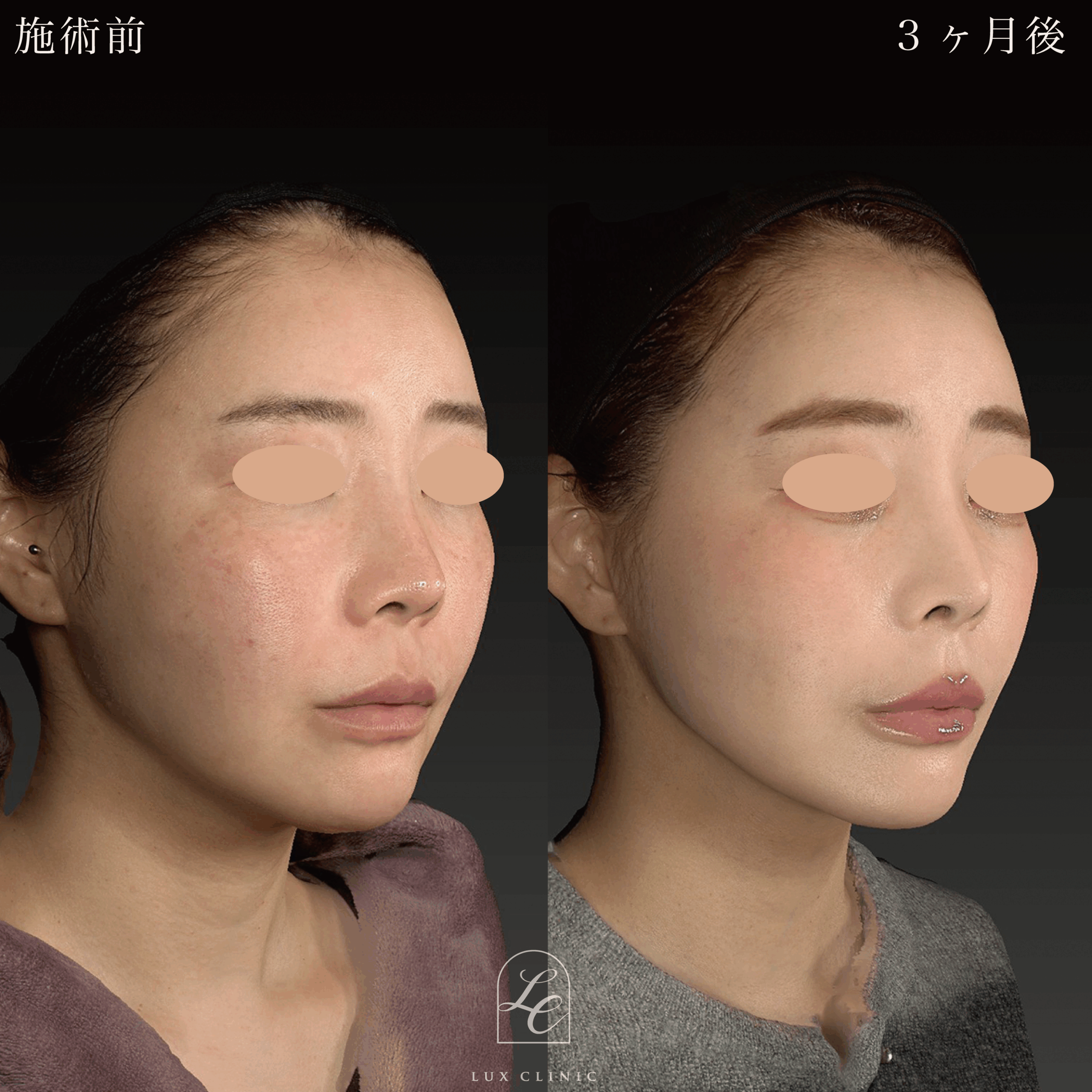 ミニフェイスリフト ＋ 糸リフト 10本