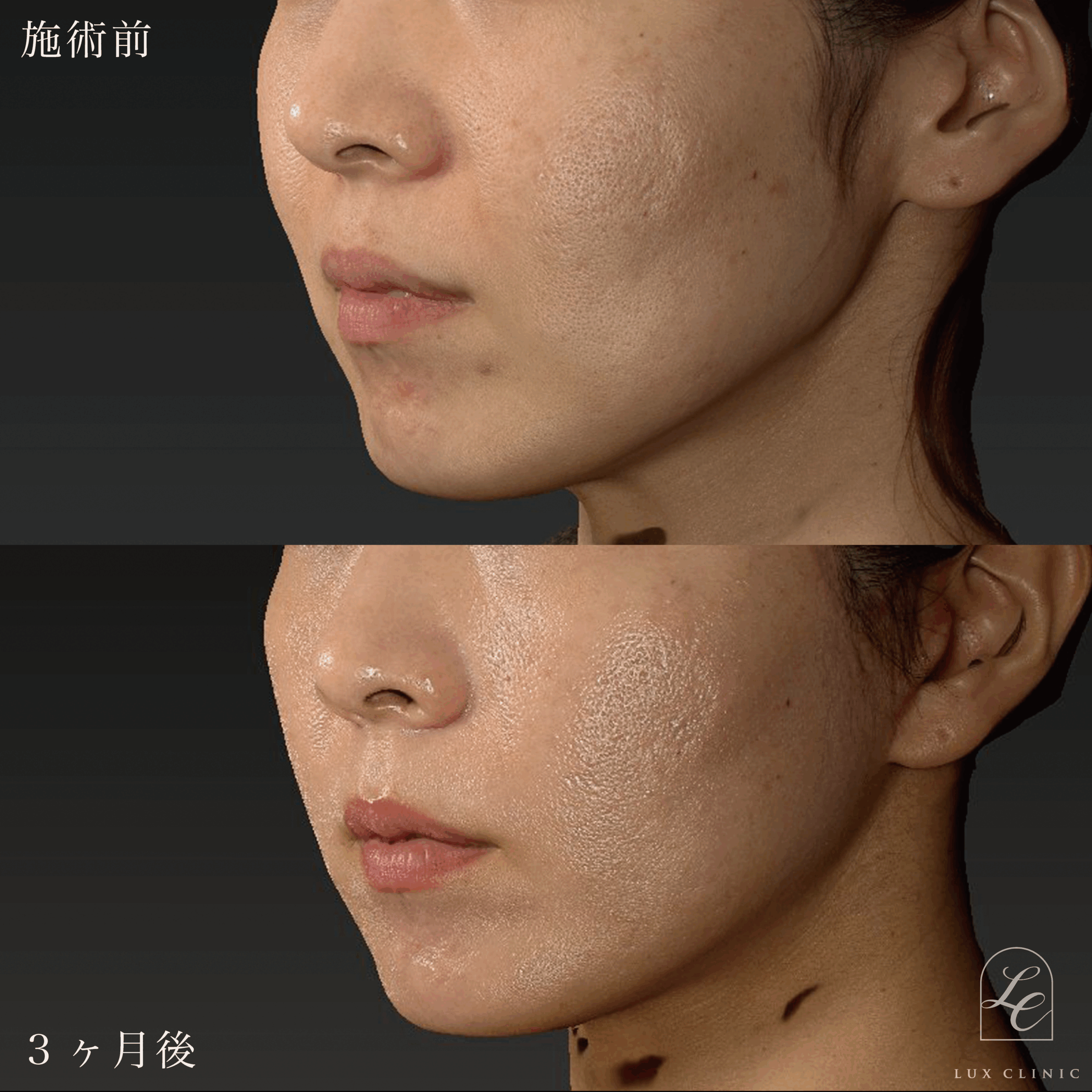 ミニフェイスリフト ＋ もみあげリフト ＋コンデンスリッチ脂肪注入 ＜顔全体・首＞ ※顔出しモニター