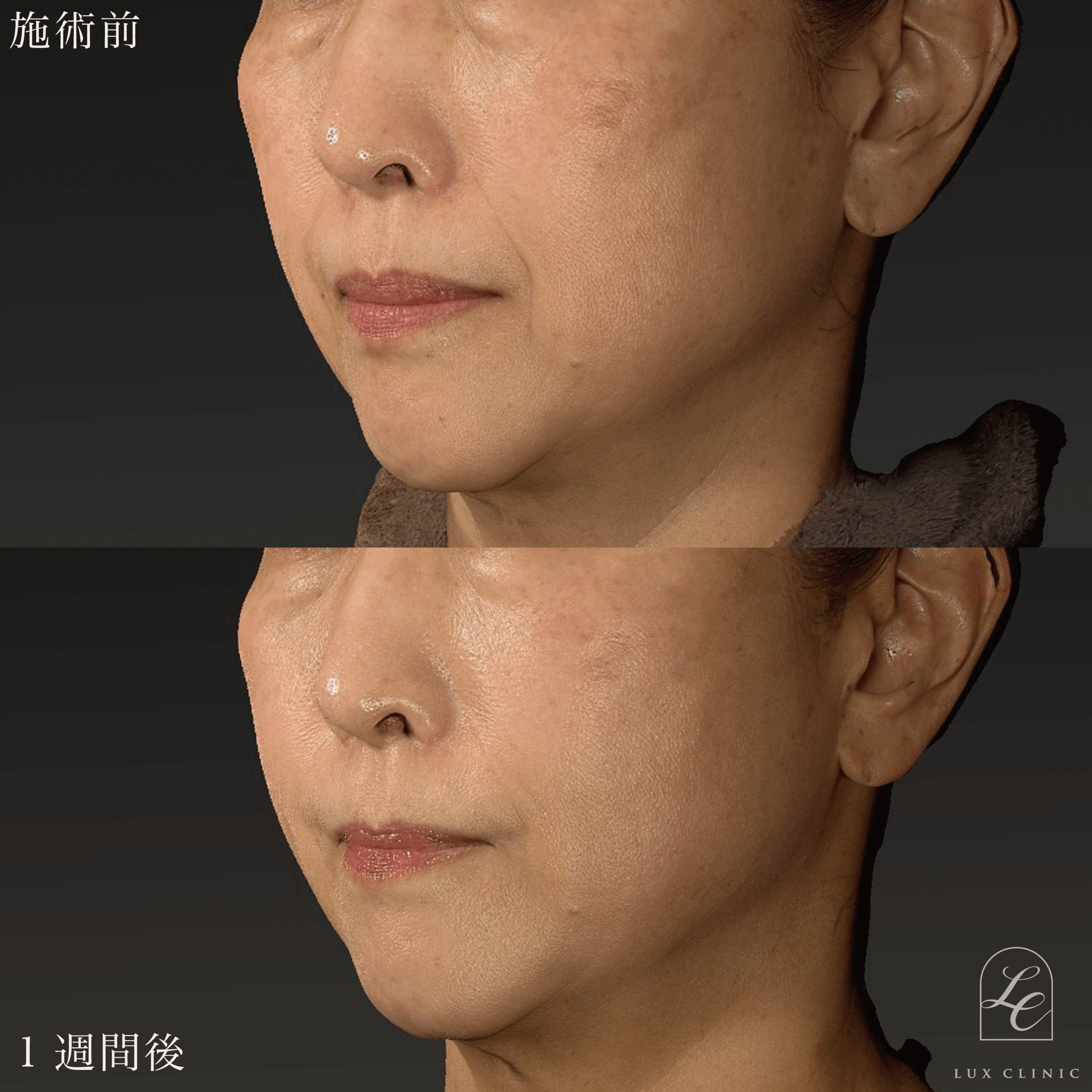 糸リフト（テスリフト 6本）＋ ヒアルロン酸（ニューラミス2本）＜ほうれい線・口角＞