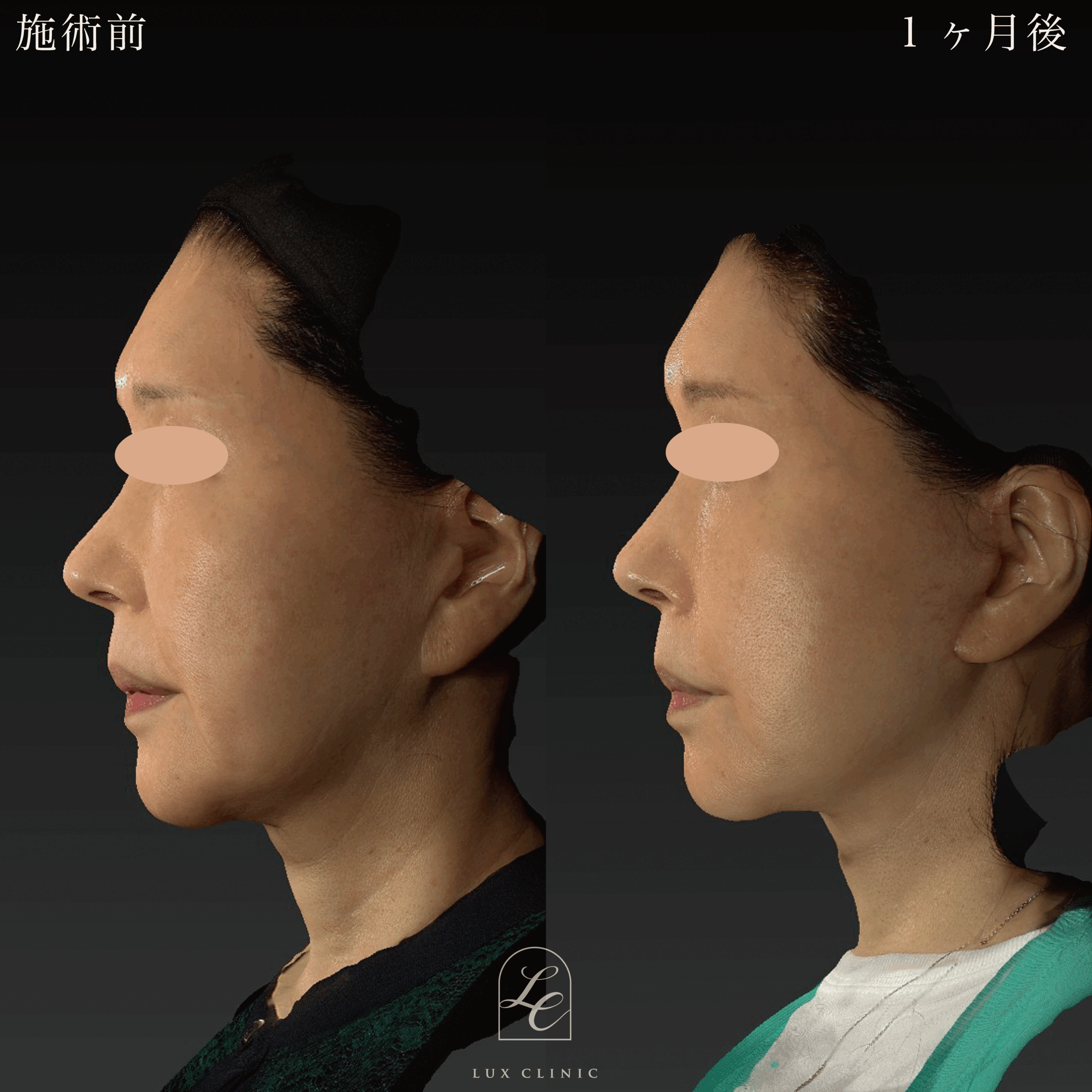 ミニフェイスリフト