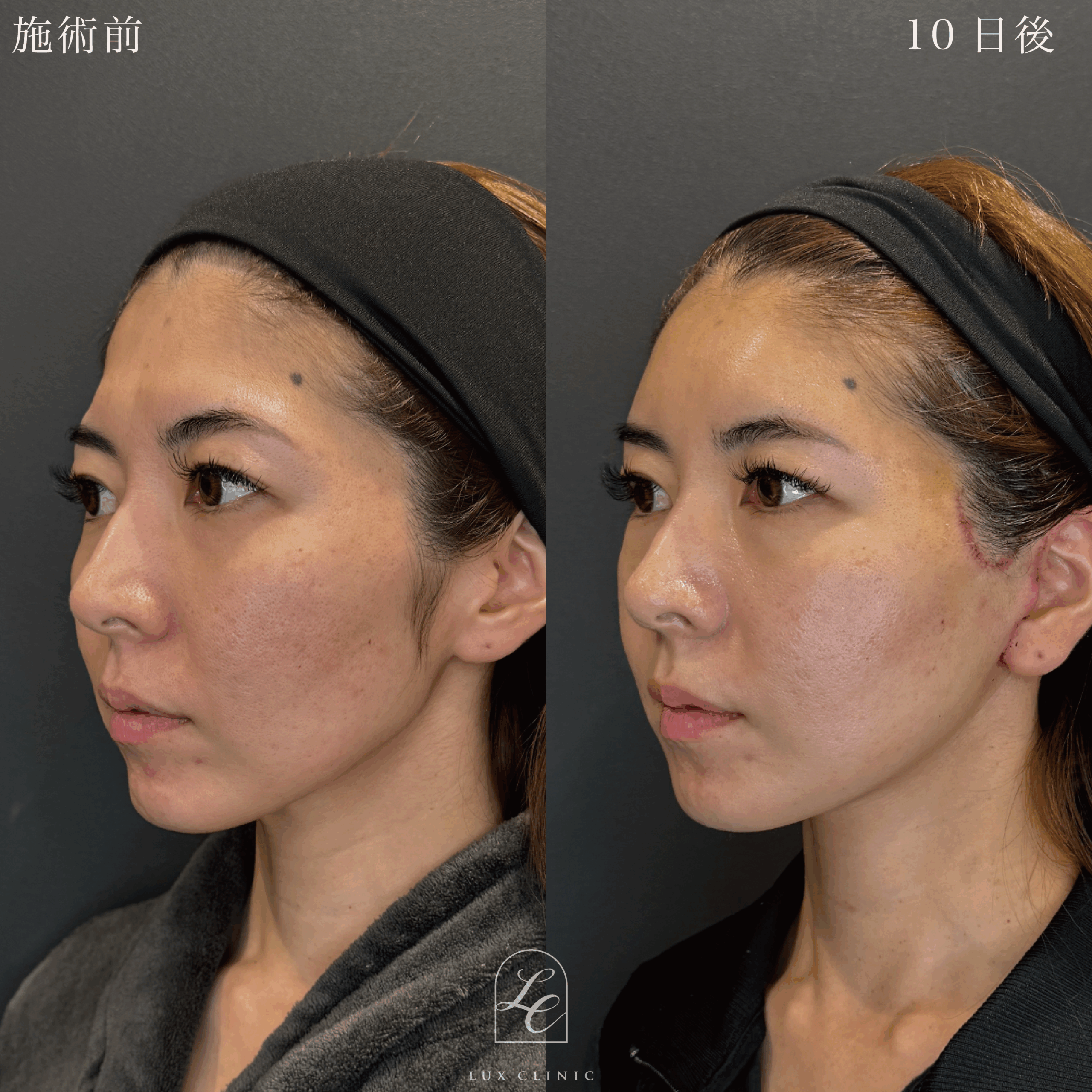 ミニフェイスリフト ＋ もみあげリフト ＋コンデンスリッチ脂肪注入 ＜顔全体・首＞ ※顔出しモニター