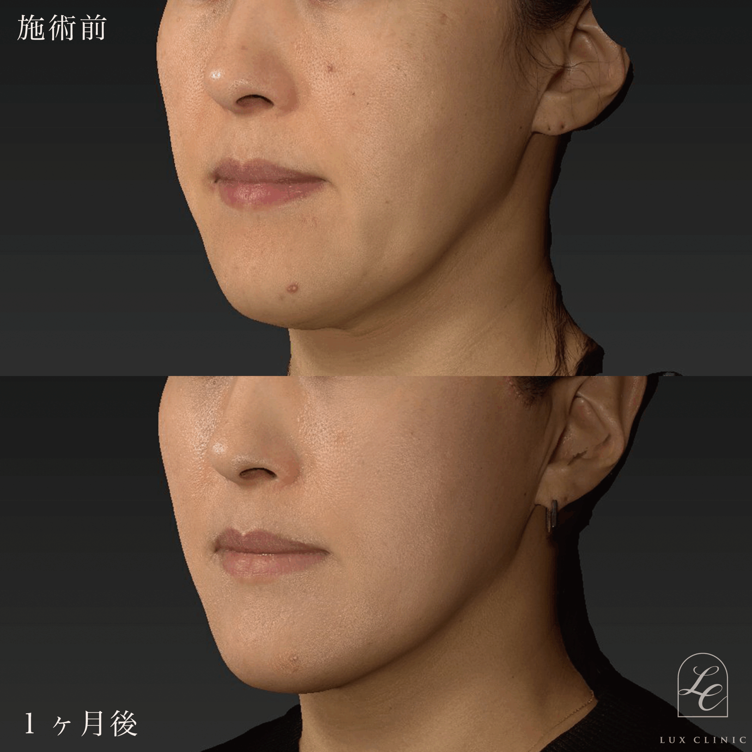 もみあげリフト