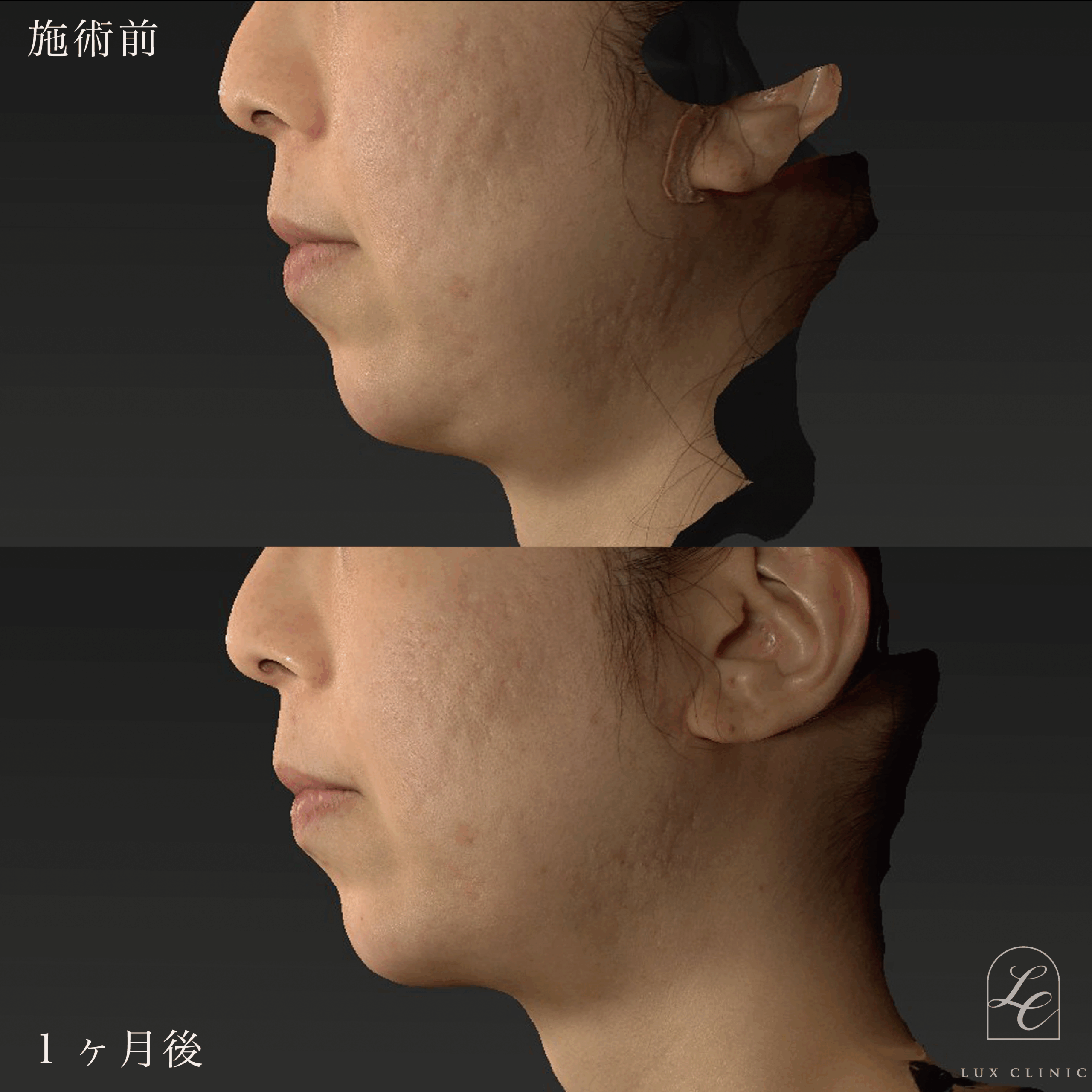 インモードVリフト（miniFX＋FORMA）1 回