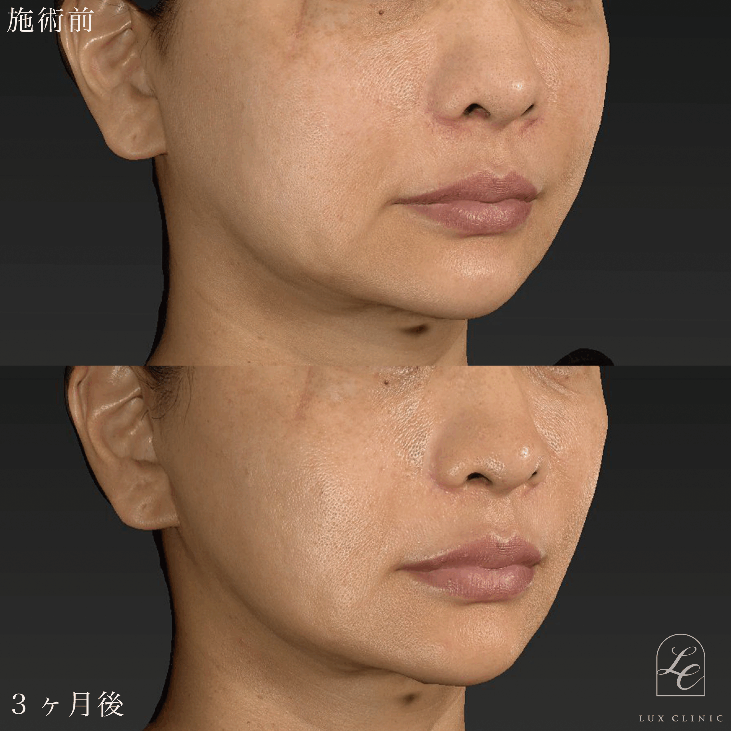 ミニフェイスリフト ＋ 糸リフト 10本