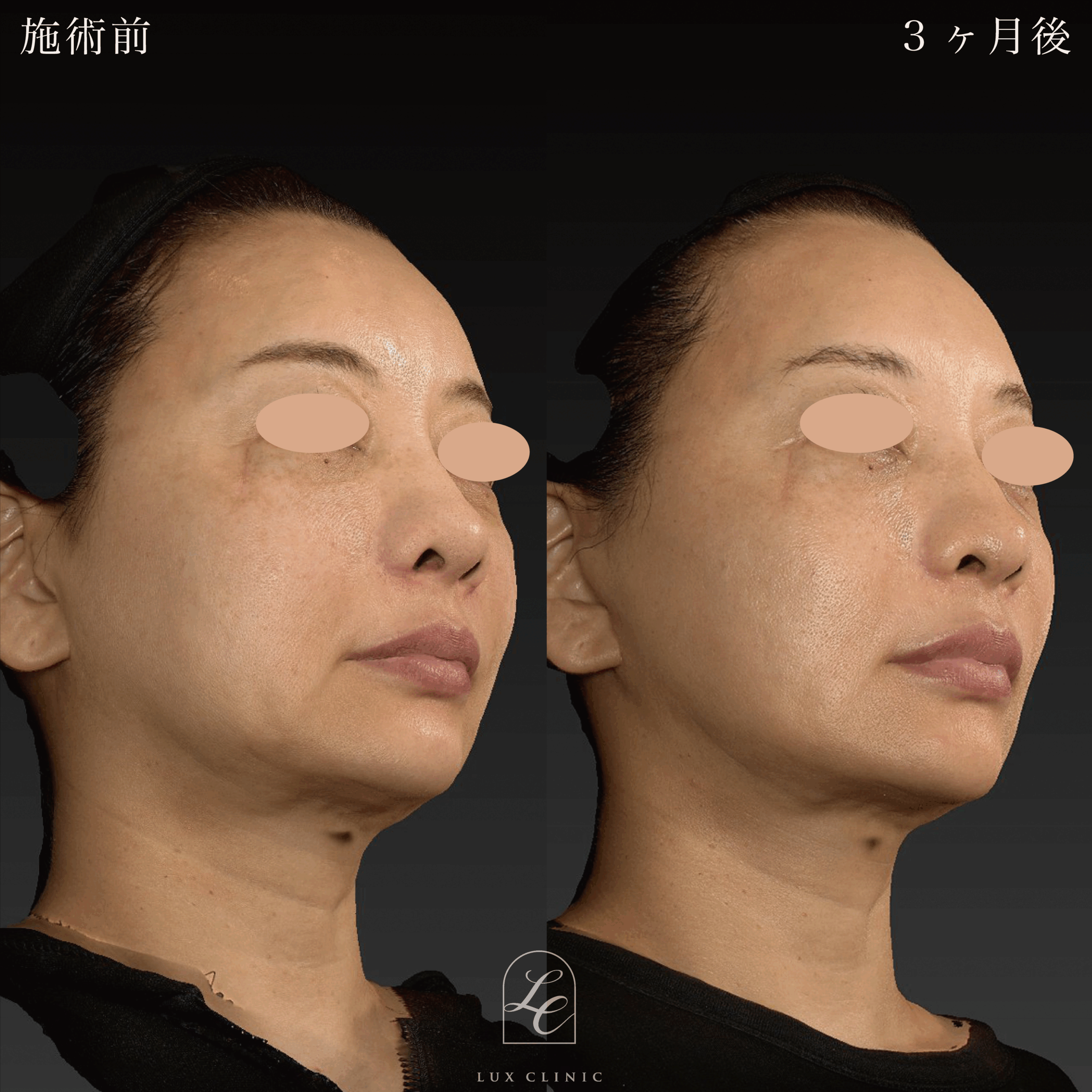 ミニフェイスリフト ＋ 糸リフト 10本