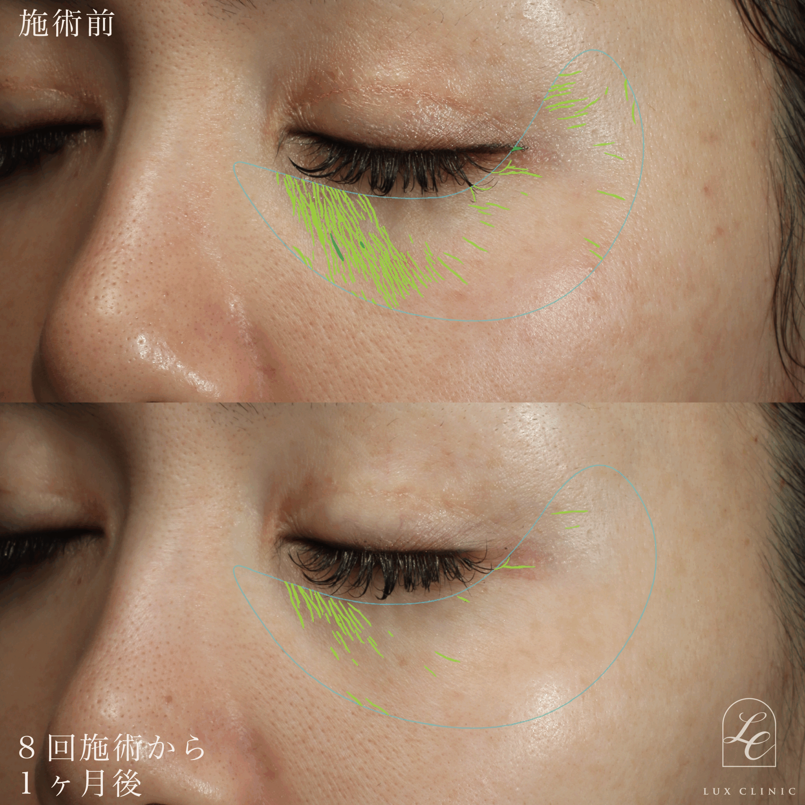 スネコス＜目の下＞ 8回