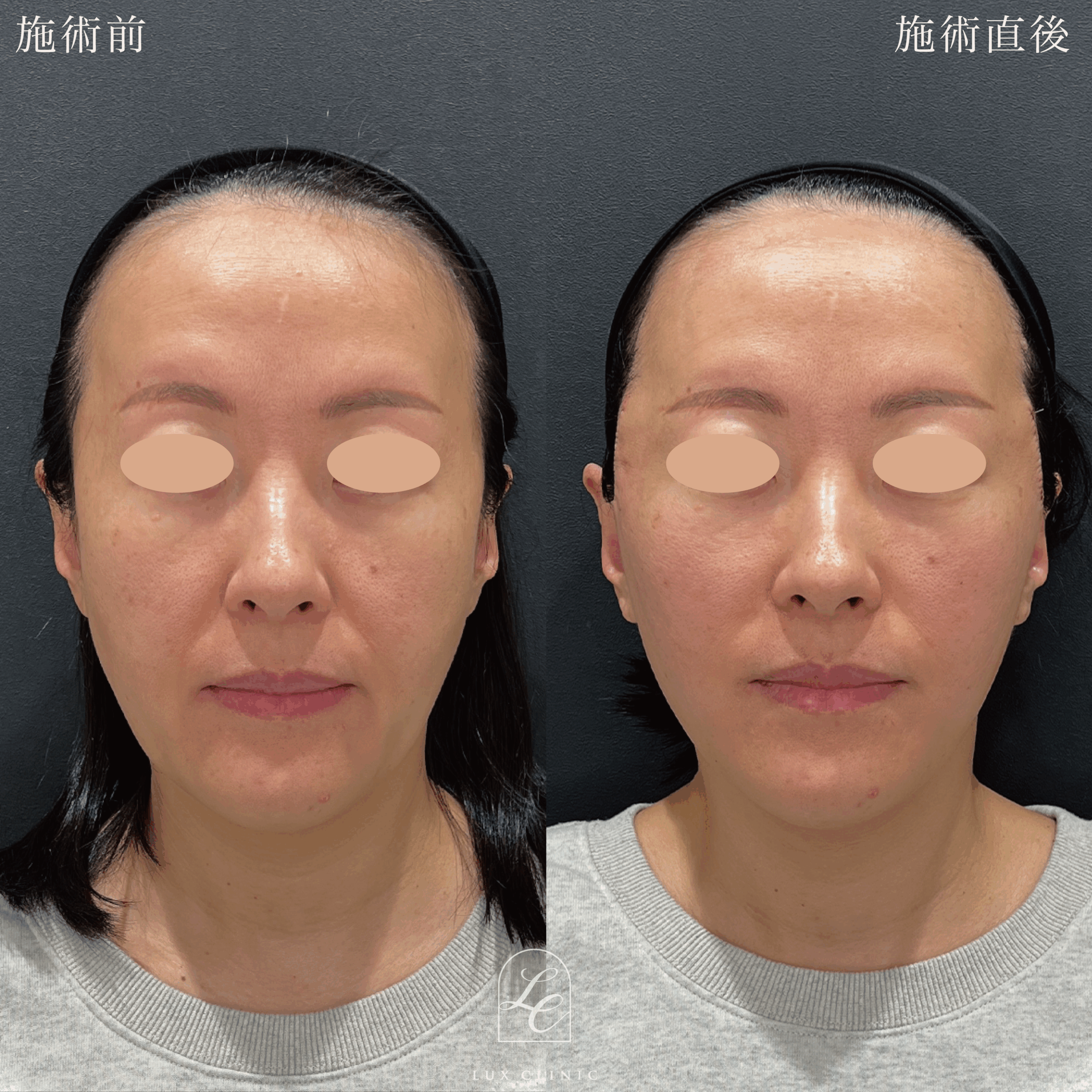 もみあげリフト