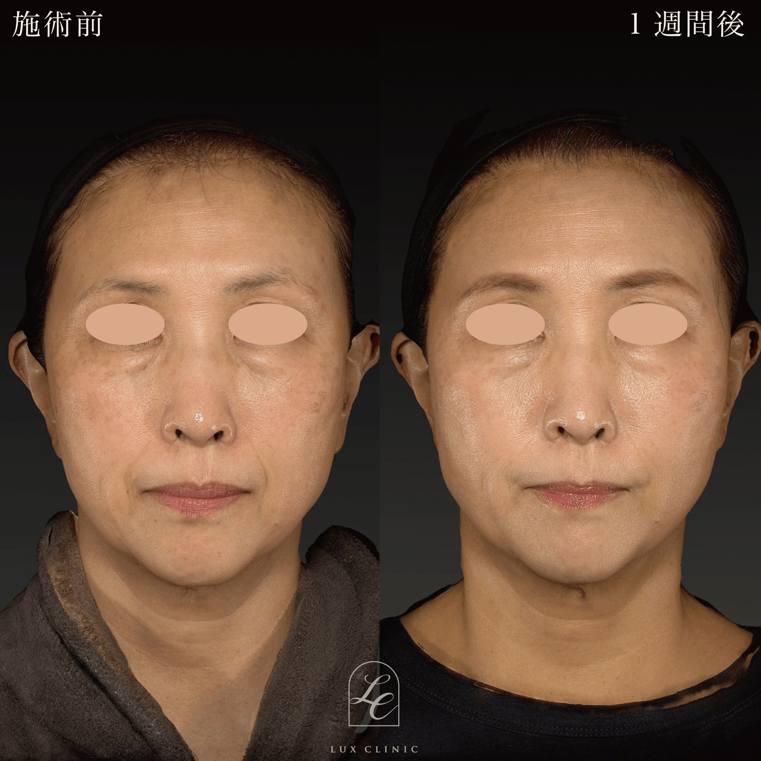 糸リフト（テスリフト 6本）＋ ヒアルロン酸（ニューラミス2本）＜ほうれい線・口角＞