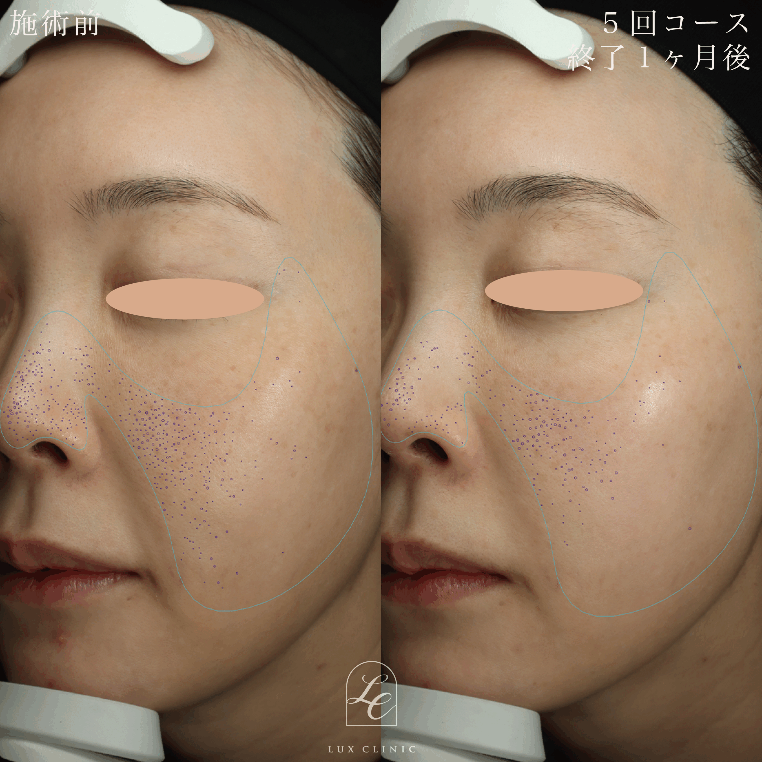 シルファーム＜全顔＞5回