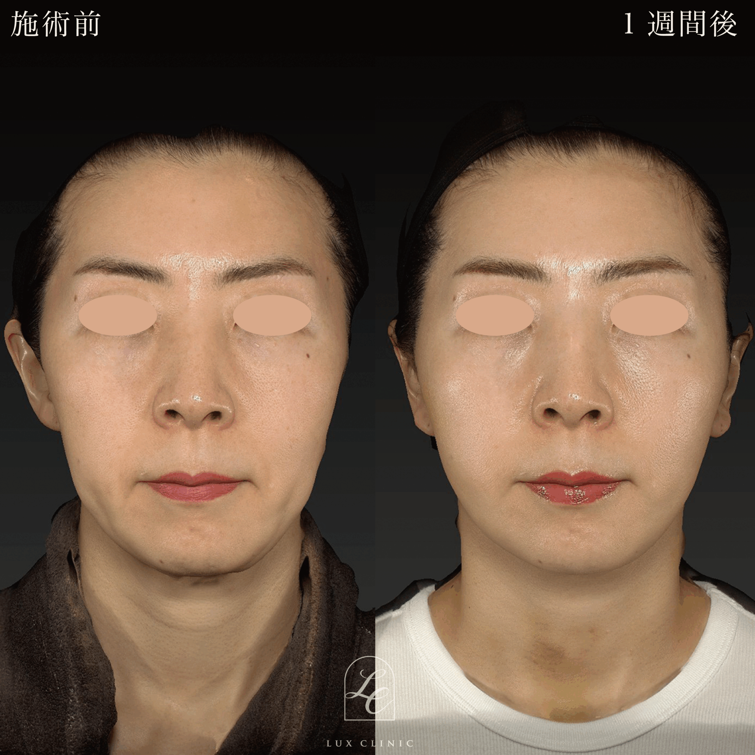 ミニフェイスリフト ＋ ヒアルロン酸（ジュビダームビスタシリーズ ボライト2本）＜首＞