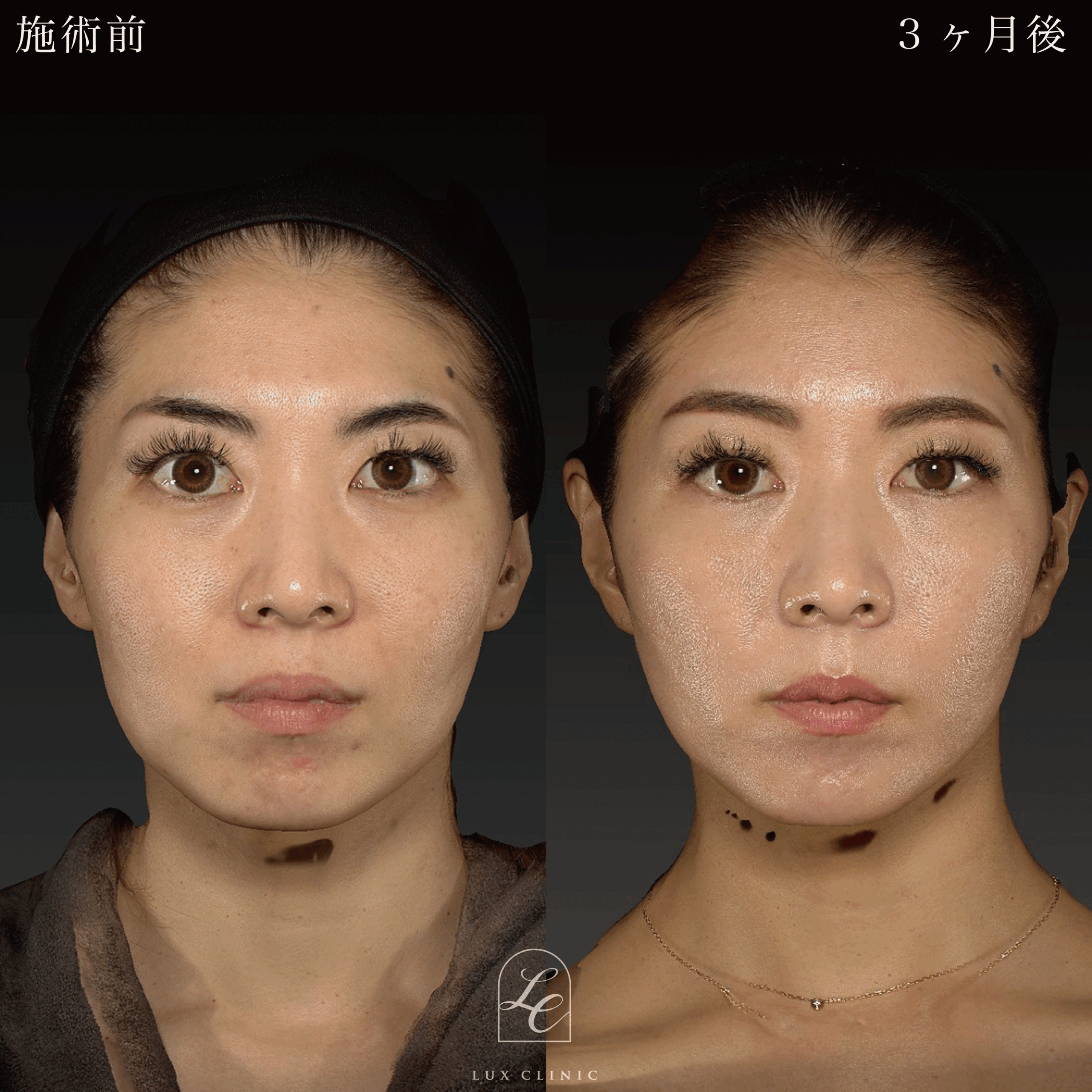 ミニフェイスリフト ＋ もみあげリフト ＋コンデンスリッチ脂肪注入 ＜顔全体・首＞ ※顔出しモニター