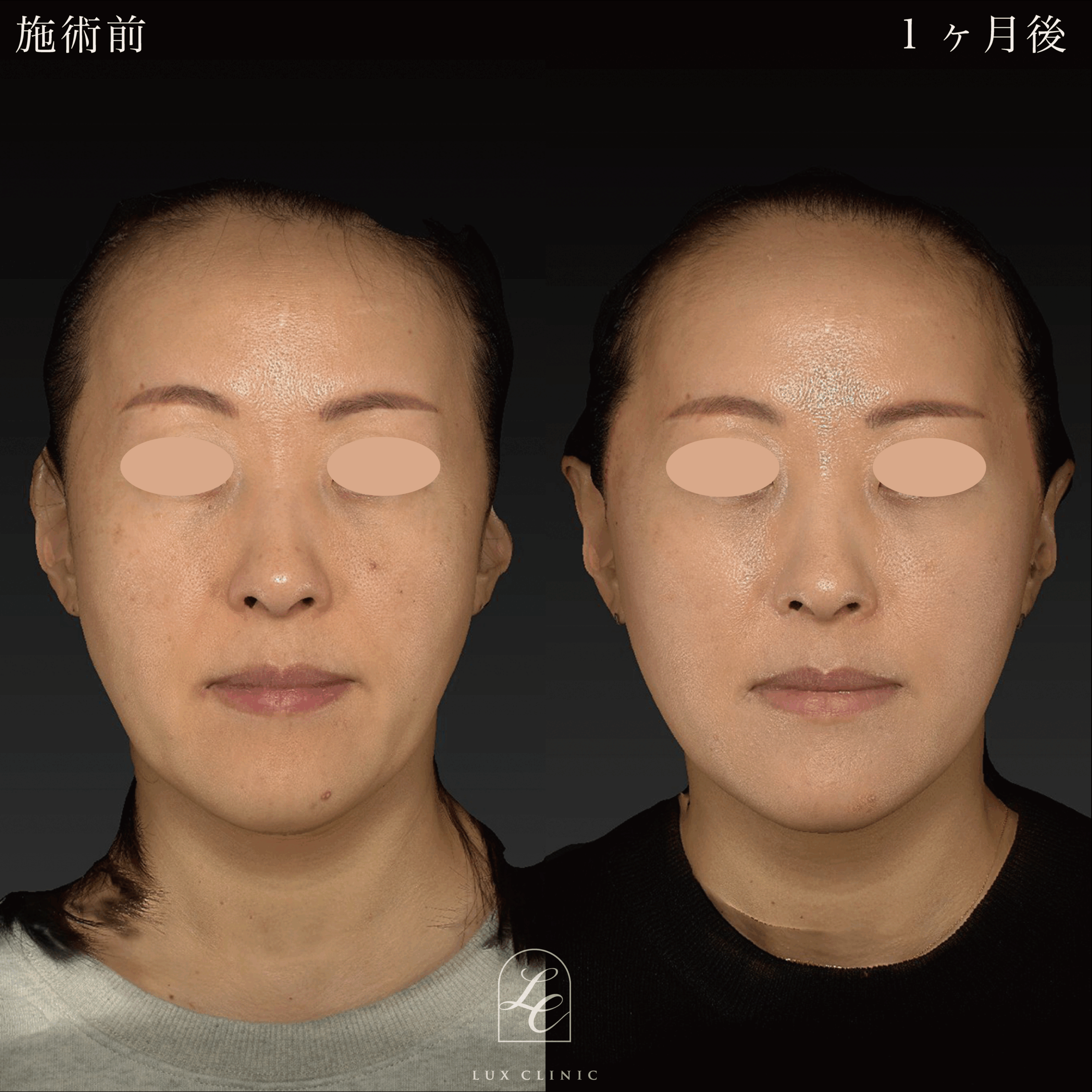 もみあげリフト