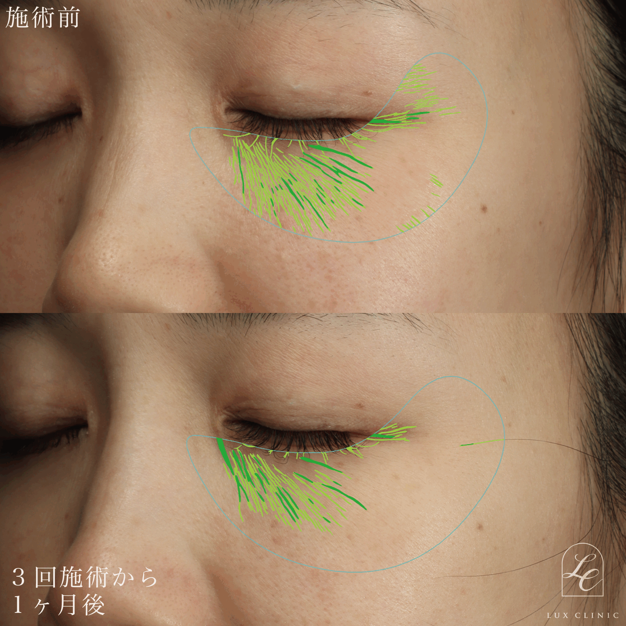 スネコス＜目の下＞ 3回