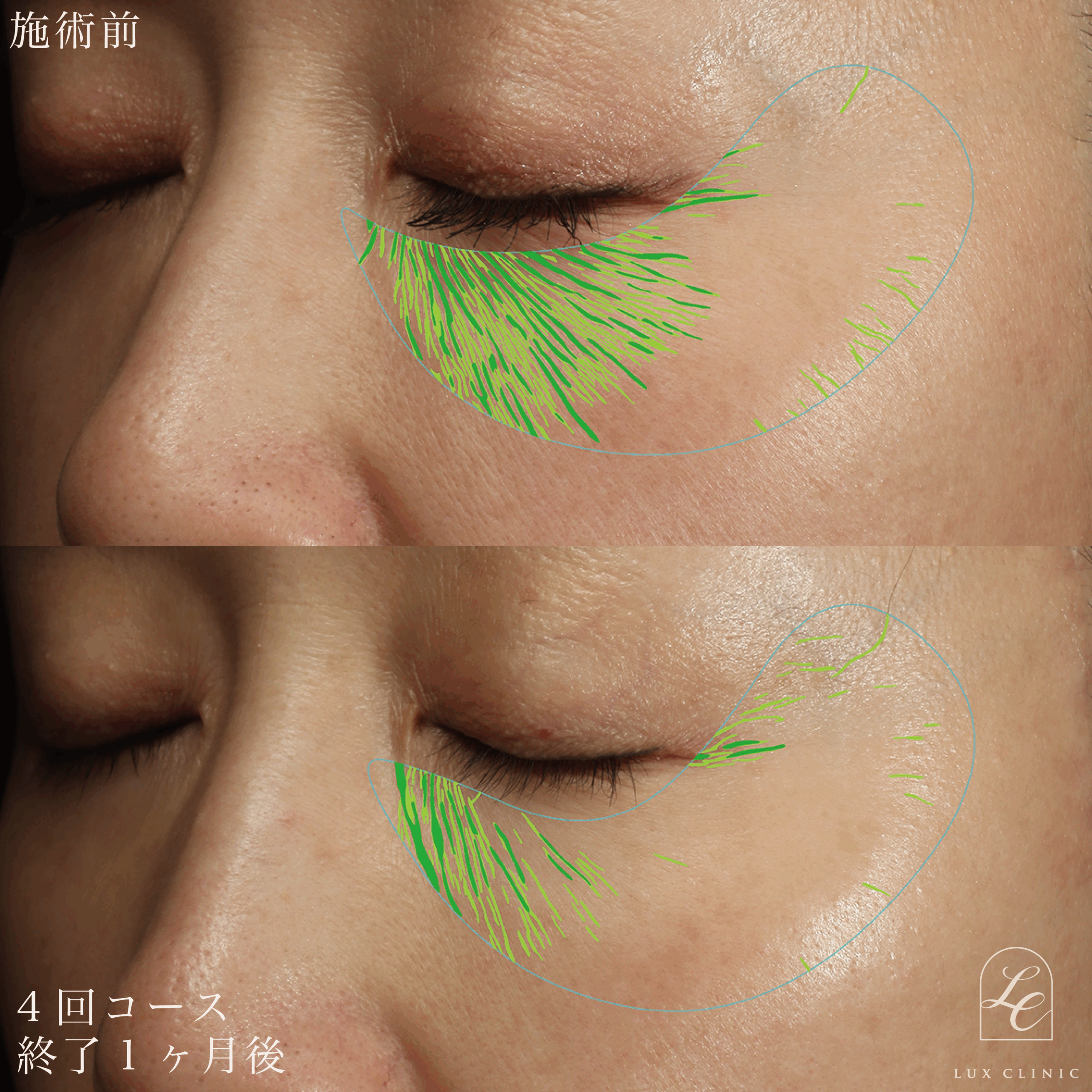 スネコス＜目の下＞ 3回