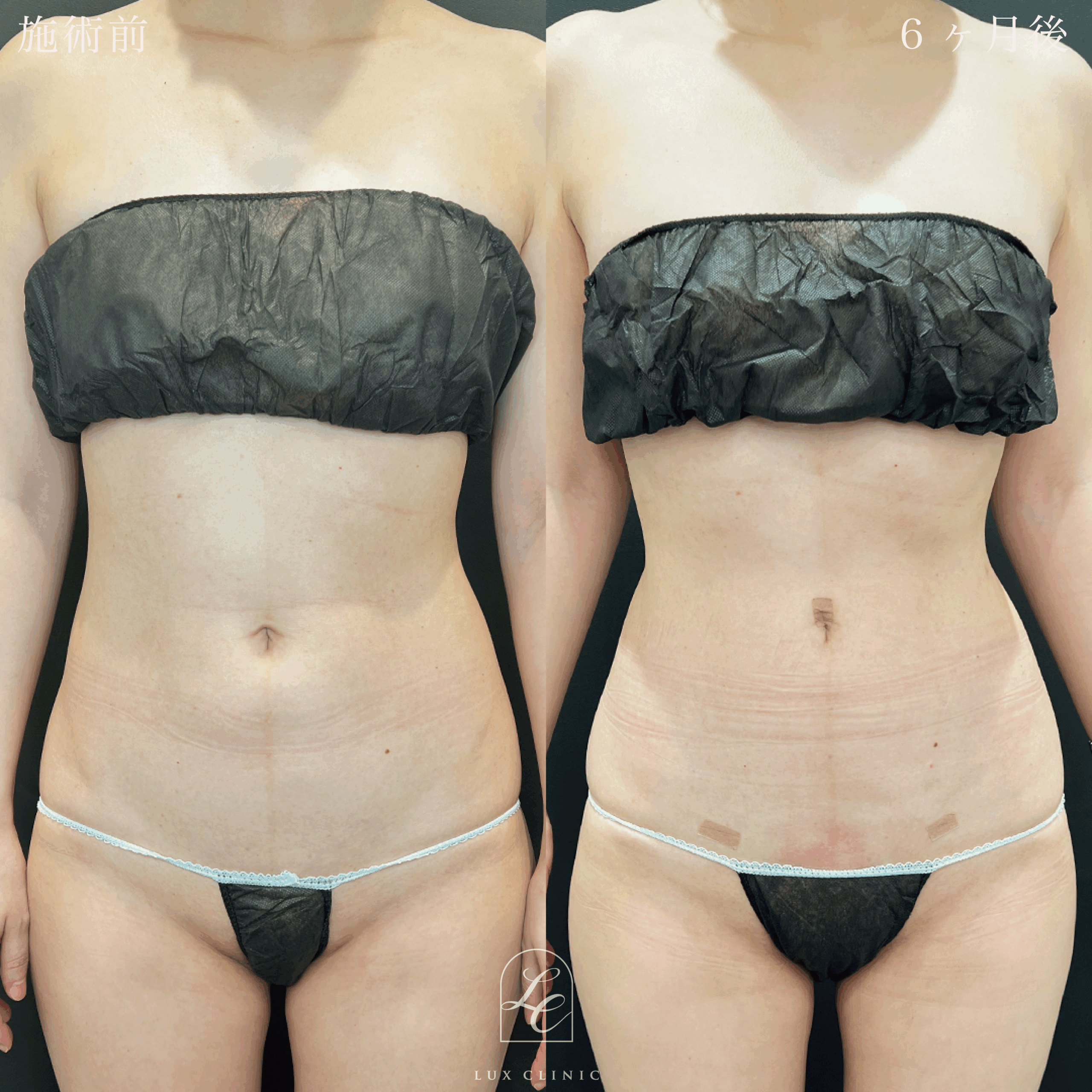 Ultra-Z 脂肪吸引 ＜腹部前面（上・下）・脇腹（前）＞