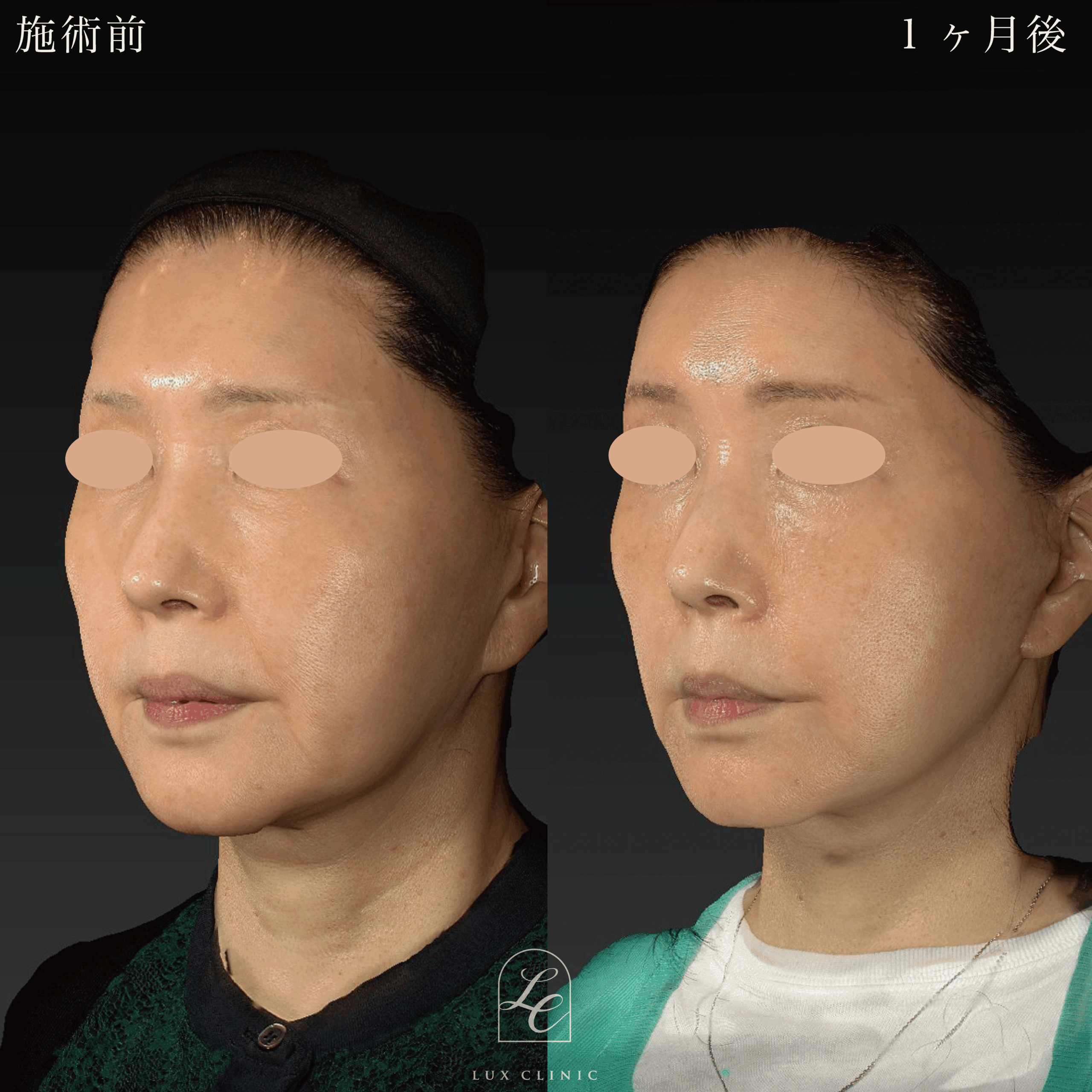 ミニフェイスリフト