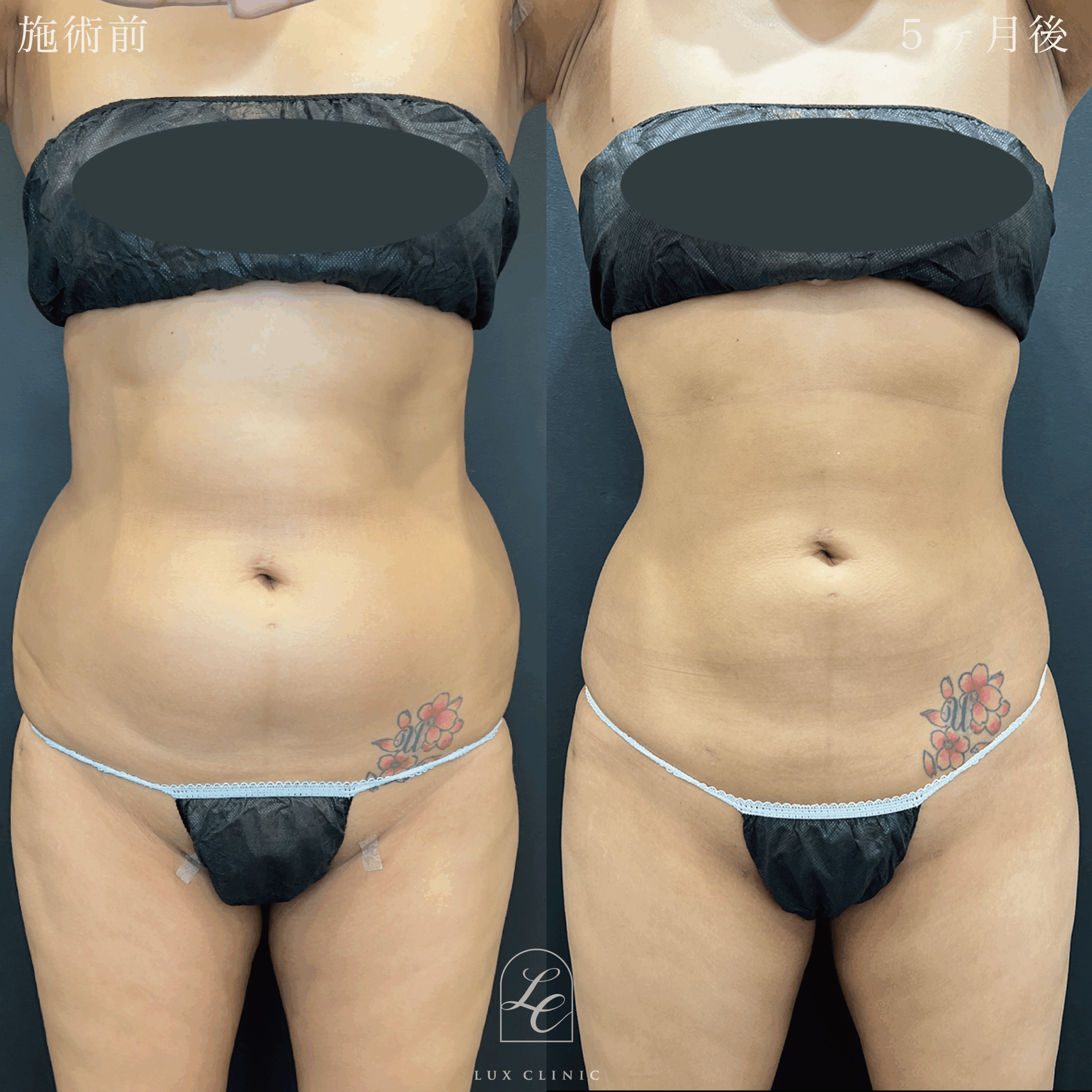 Ultra-Z 脂肪吸引 ＜腹部前面（上・下）・脇腹（前・後）・腰・ブラ下＞